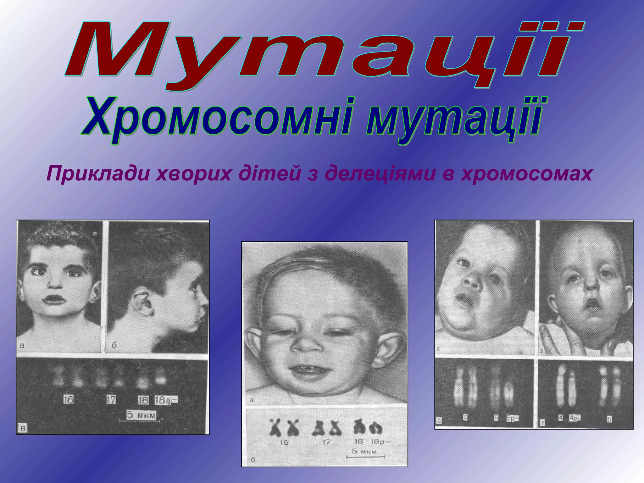 Приклади хворих дітей з делеціями в хромосомах
 