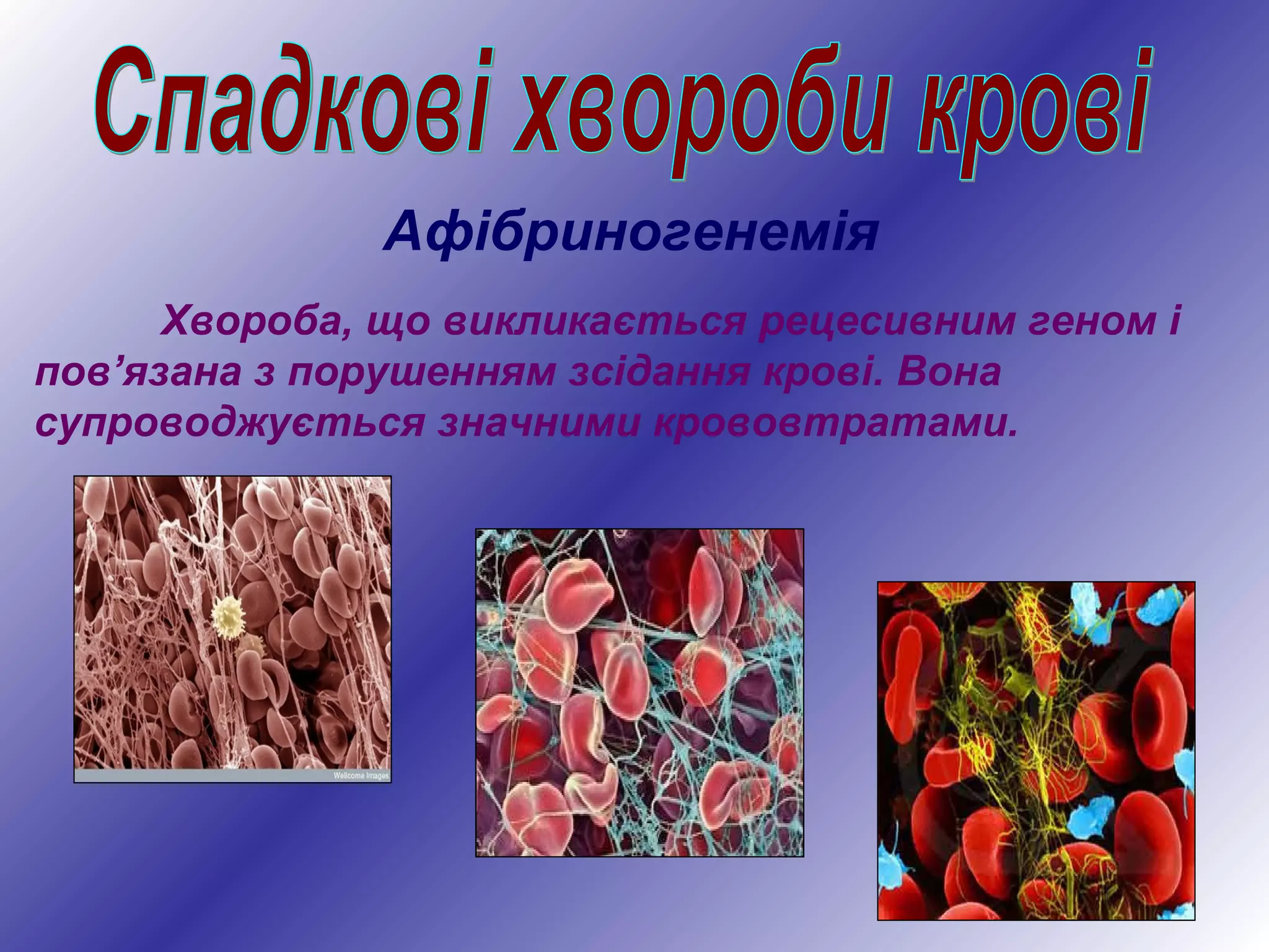 Хвороба, що викликається рецесивним геном і
пов’язана з порушенням зсідання крові. Вона
супроводжується значними крововтратами.
Афібриногенемія
 