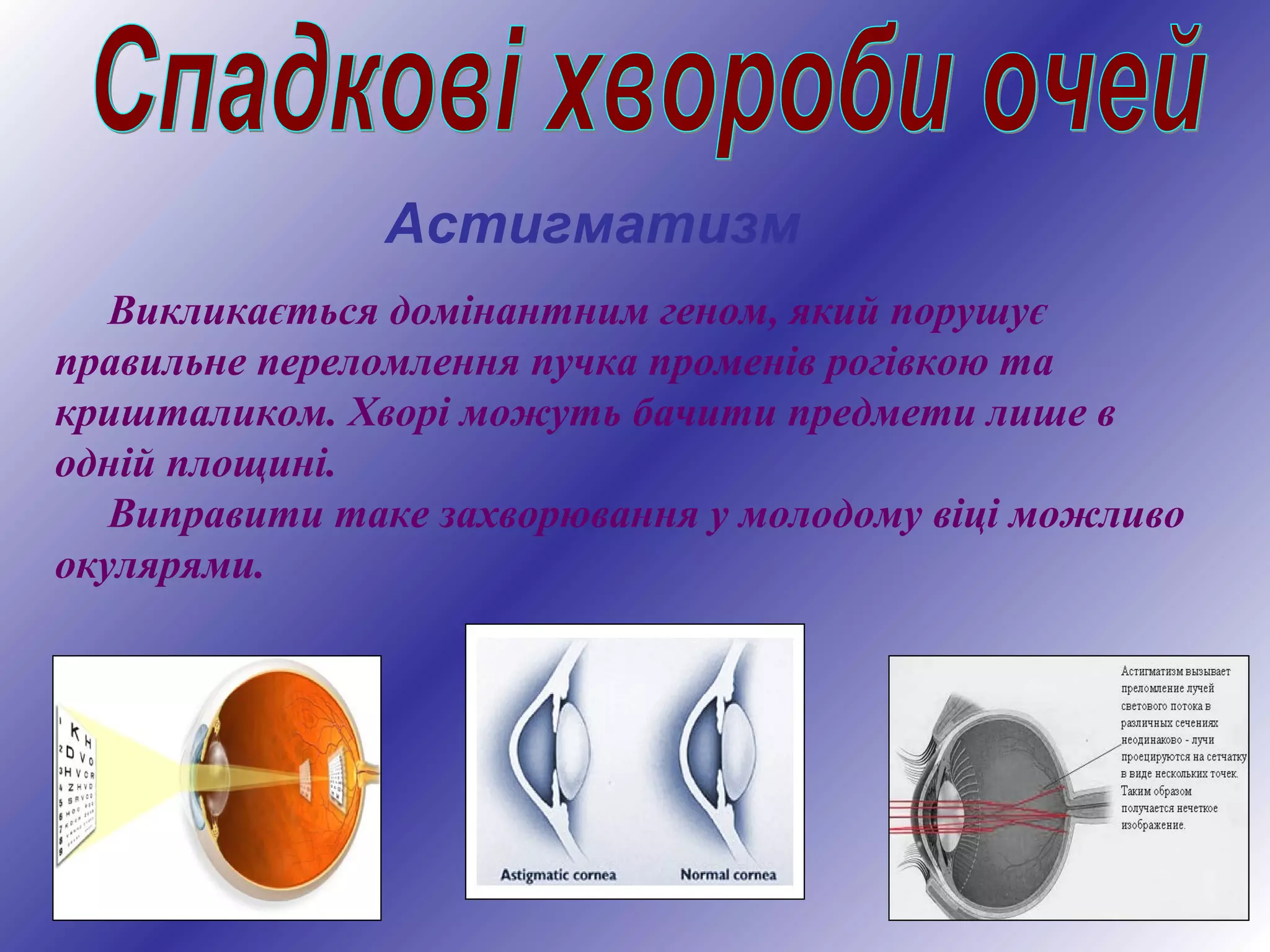 Викликається домінантним геном, який порушує
правильне переломлення пучка променів рогівкою та
кришталиком. Хворі можуть бачити предмети лише в
одній площині.
Виправити таке захворювання у молодому віці можливо
окулярями.
Астигматизм
 