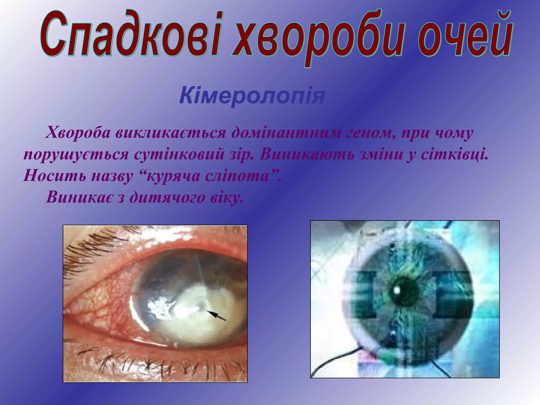 Кімеролопія
Хвороба викликається домінантним геном, при чому
порушується сутінковий зір. Виникають зміни у сітківці.
Носить назву “куряча сліпота”.
Виникає з дитячого віку.
 