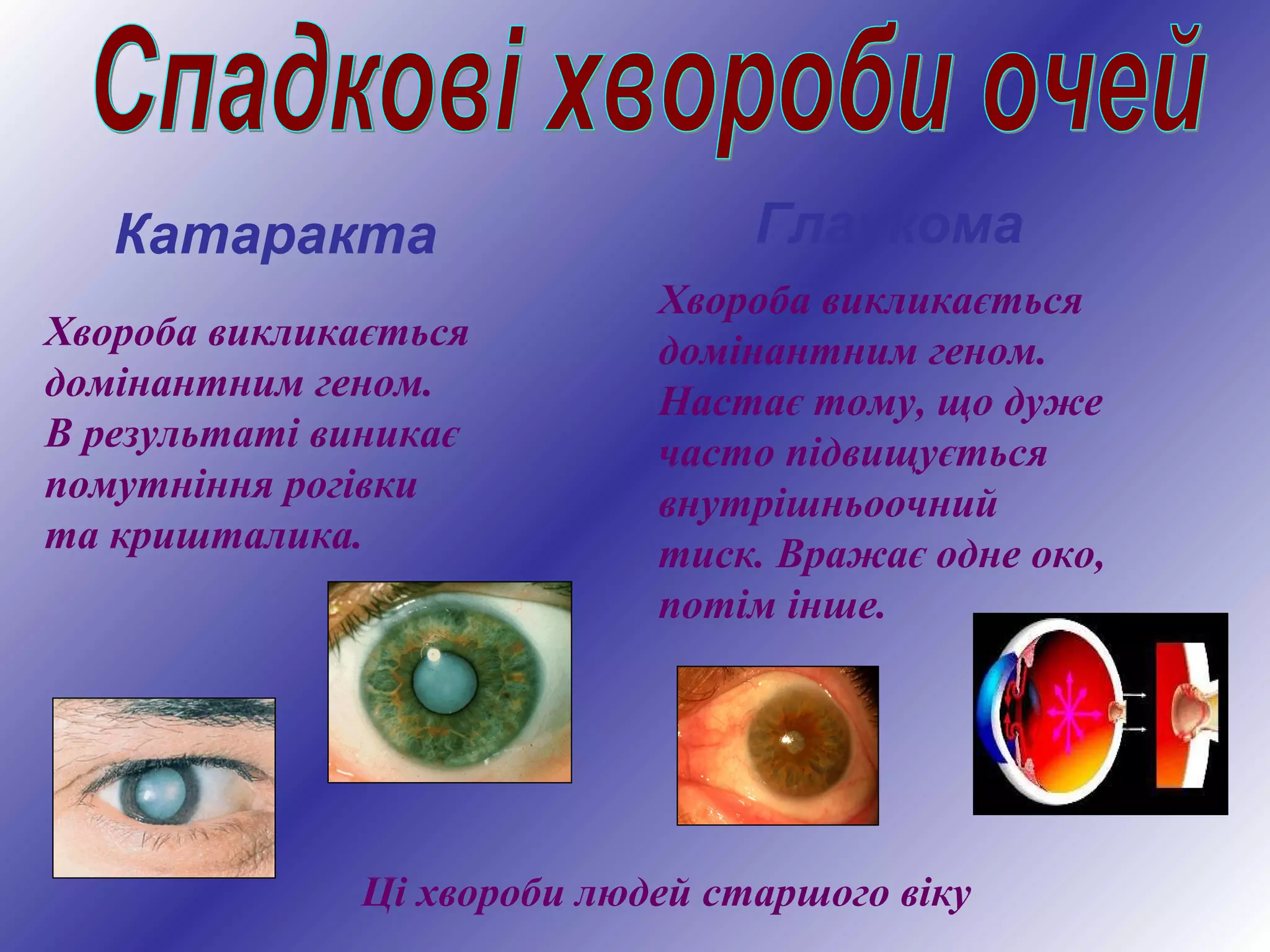 Катаракта
Хвороба викликається
домінантним геном.
В результаті виникає
помутніння рогівки
та кришталика.
Глаукома
Хвороба викликається
домінантним геном.
Настає тому, що дуже
часто підвищується
внутрішньоочний
тиск. Вражає одне око,
потім інше.
Ці хвороби людей старшого віку
 