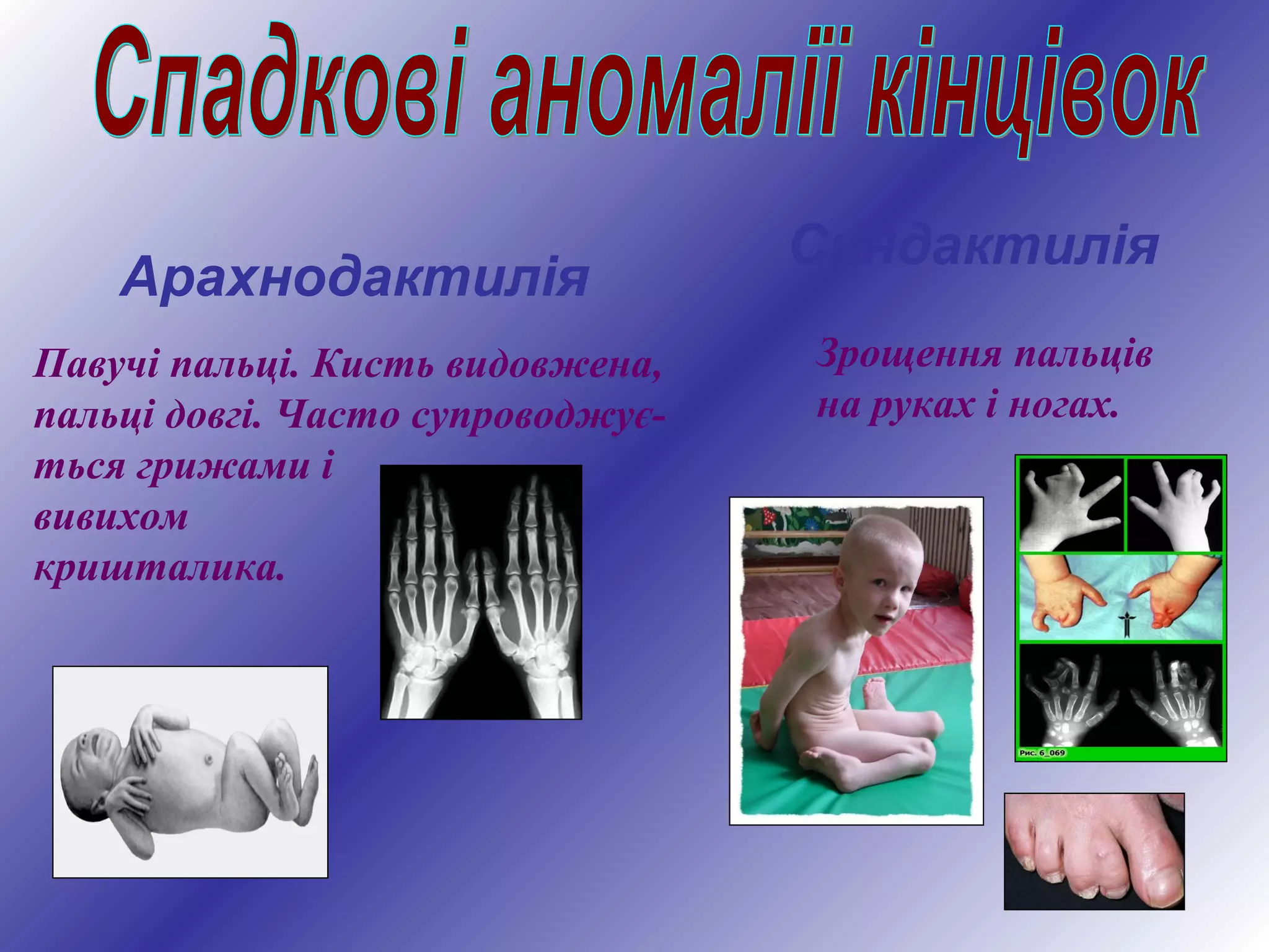 Синдактилія
Арахнодактилія
Павучі пальці. Кисть видовжена,
пальці довгі. Часто супроводжує-
ться грижами і
вивихом
кришталика.
Зрощення пальців
на руках і ногах.
 