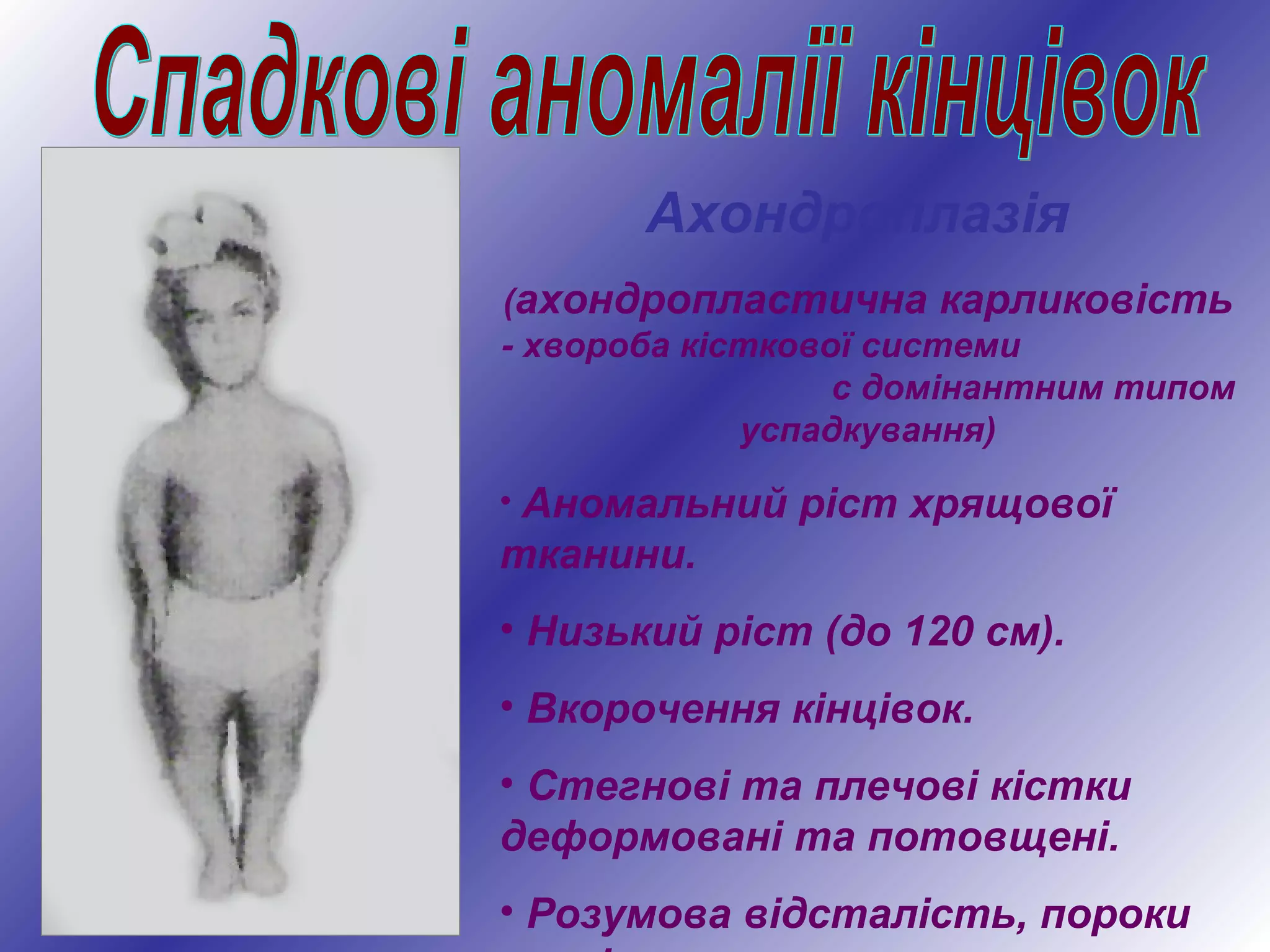 Ахондроплазія
(ахондропластична карликовість
- хвороба кісткової системи
с домінантним типом
успадкування)
• Аномальний ріст хрящової
тканини.
• Низький ріст (до 120 см).
• Вкорочення кінцівок.
• Стегнові та плечові кістки
деформовані та потовщені.
• Розумова відсталість, пороки
 