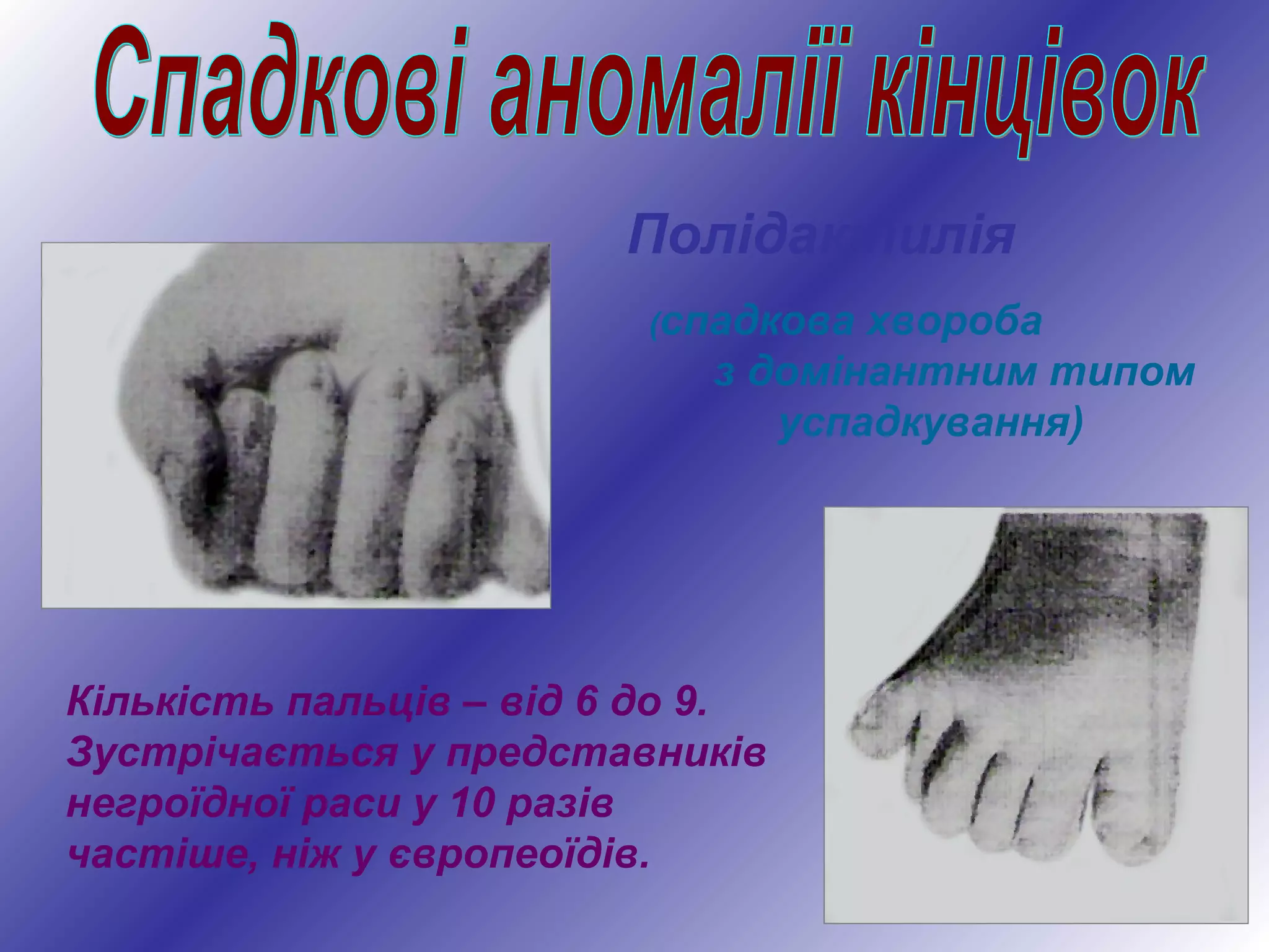 Полідактилія
(спадкова хвороба
з домінантним типом
успадкування)
Кількість пальців – від 6 до 9.
Зустрічається у представників
негроїдної раси у 10 разів
частіше, ніж у європеоїдів.
 