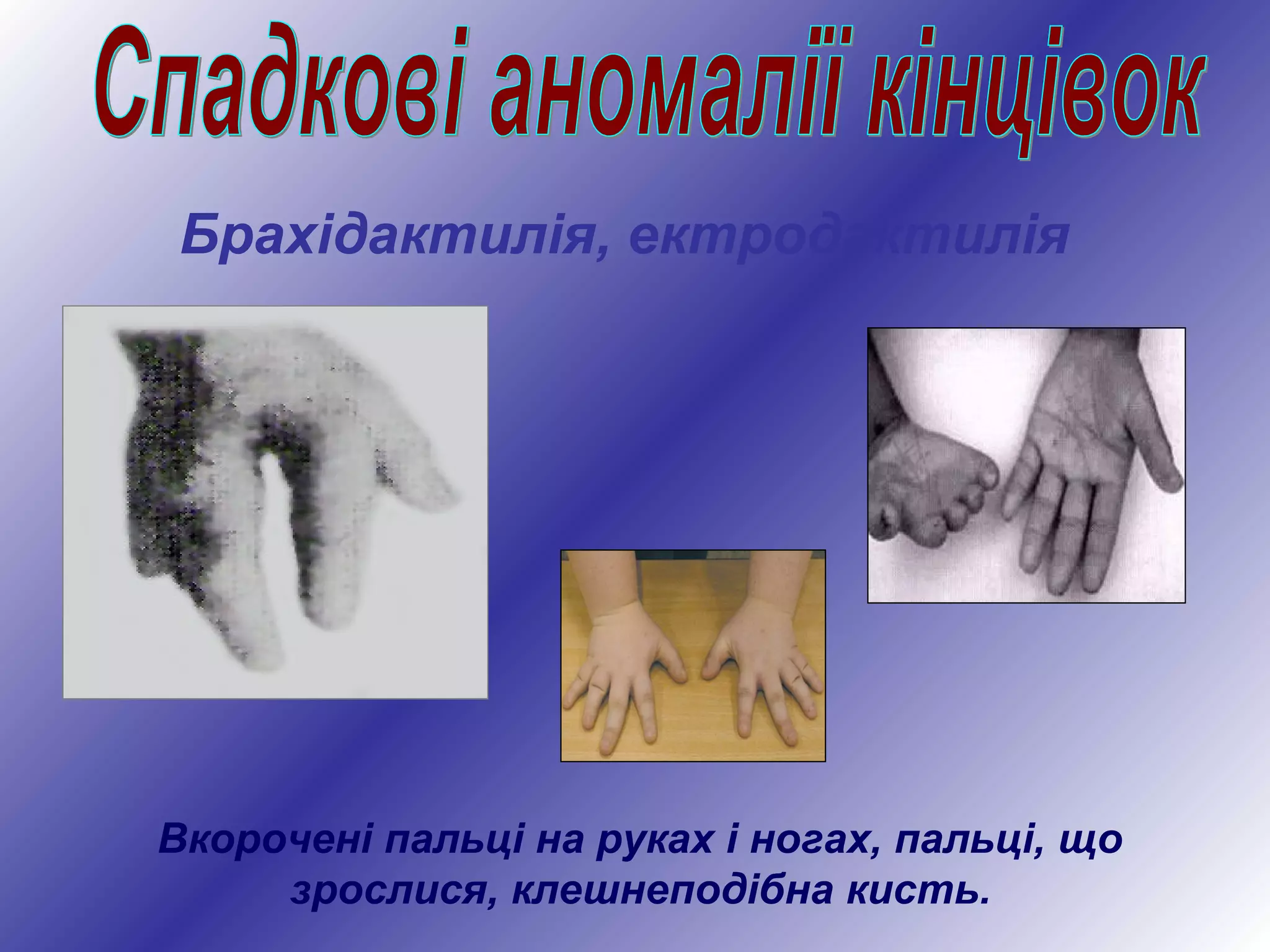 Вкорочені пальці на руках і ногах, пальці, що
зрослися, клешнеподібна кисть.
Брахідактилія, ектродактилія
 