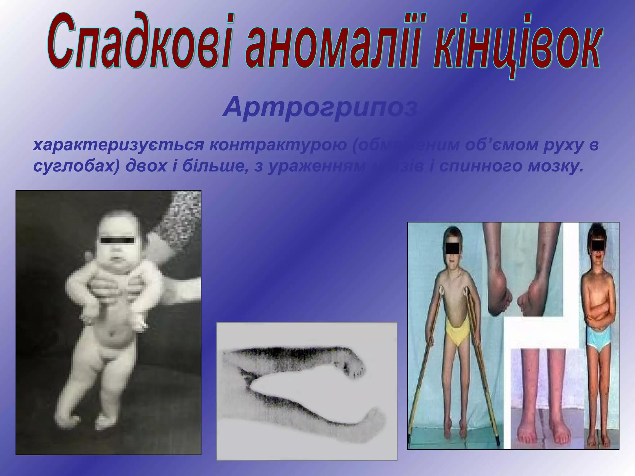 Артрогрипоз
характеризується контрактурою (обмеженим об’ємом руху в
суглобах) двох і більше, з ураженням м’язів і спинного мозку.
 