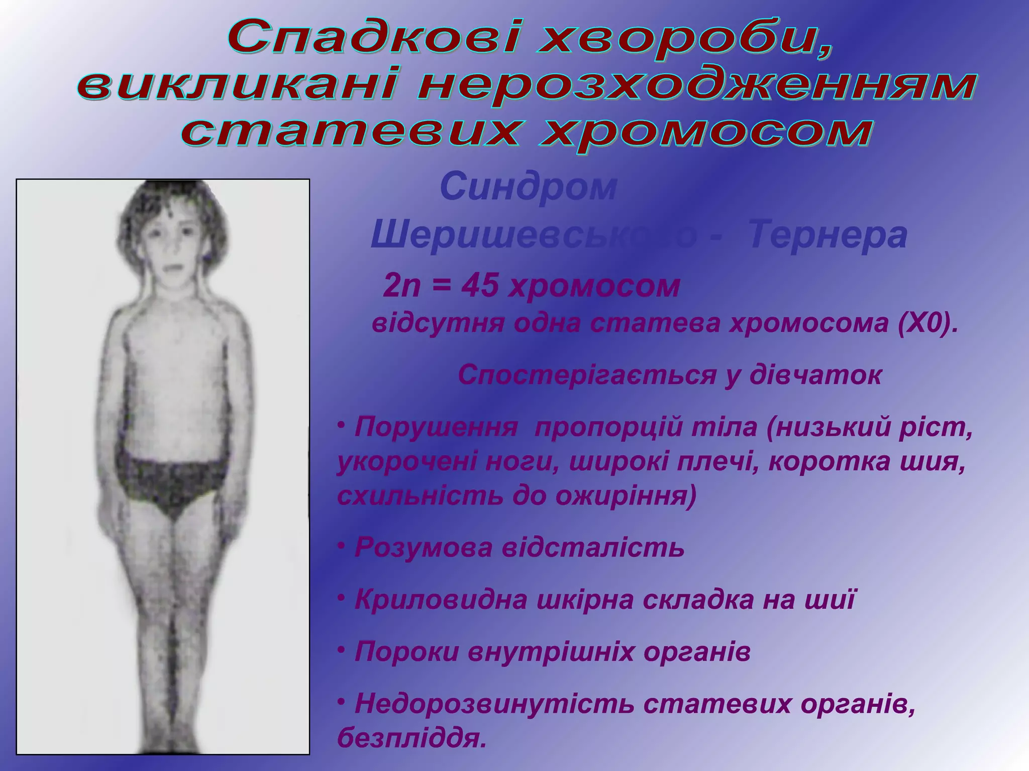 Синдром
Шеришевського - Тернера
2n = 45 хромосом
відсутня одна статева хромосома (Х0).
Спостерігається у дівчаток
• Порушення пропорцій тіла (низький ріст,
укорочені ноги, широкі плечі, коротка шия,
схильність до ожиріння)
• Розумова відсталість
• Криловидна шкірна складка на шиї
• Пороки внутрішніх органів
• Недорозвинутість статевих органів,
безпліддя.
 