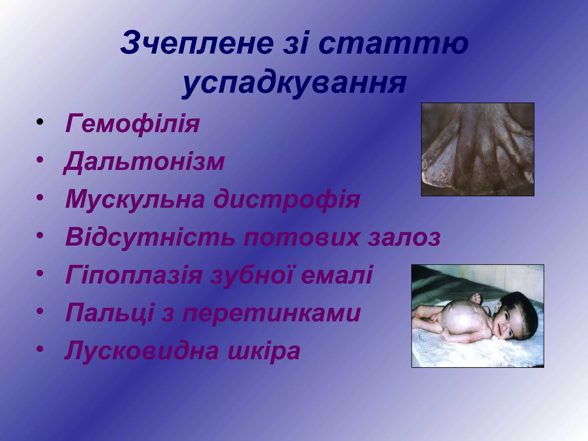 Зчеплене зі статтю
успадкування
• Гемофілія
• Дальтонізм
• Мускульна дистрофія
• Відсутність потових залоз
• Гіпоплазія зубної емалі
• Пальці з перетинками
• Лусковидна шкіра
 