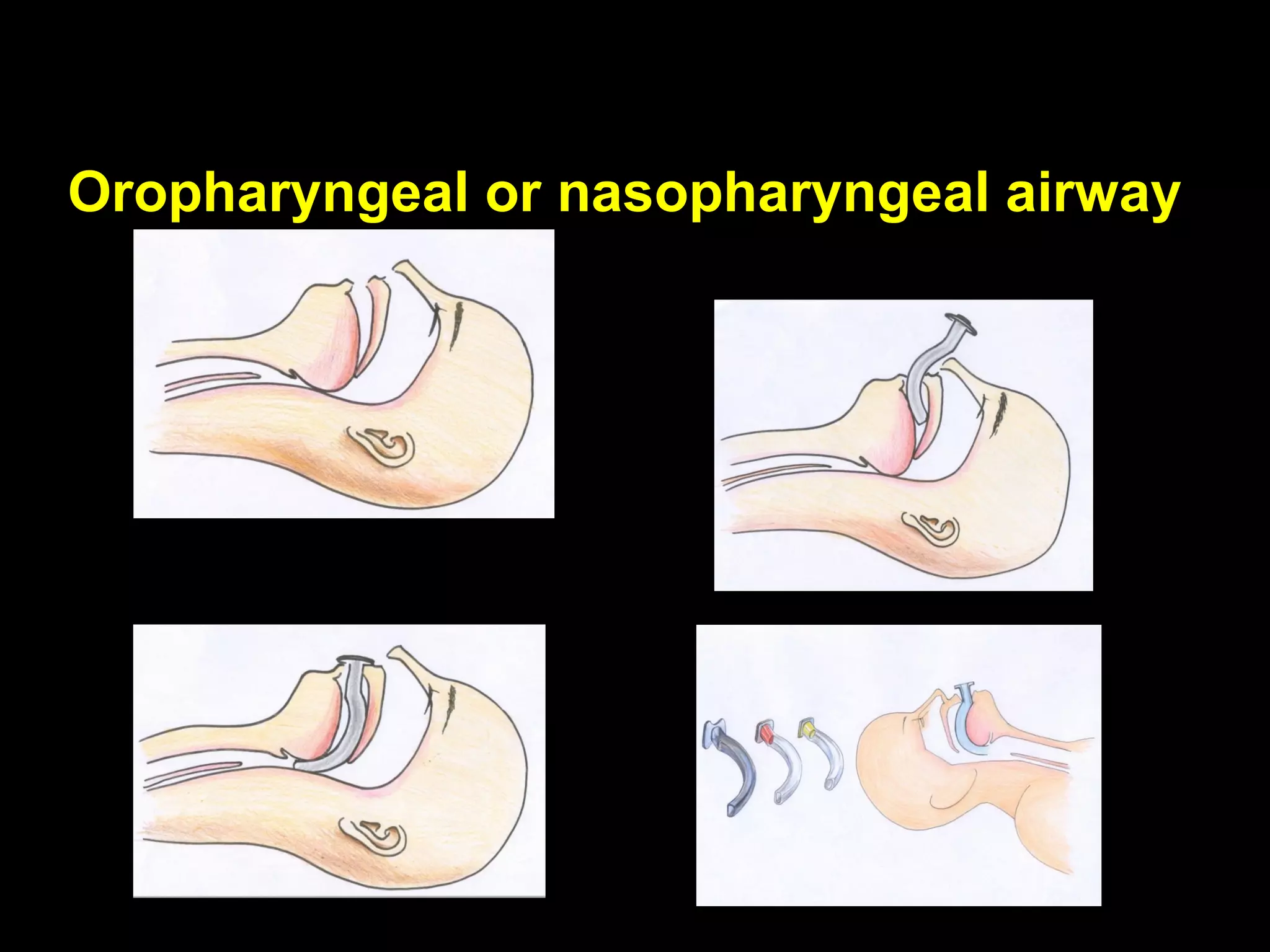 Oropharyngeal or nasopharyngeal airwayOropharyngeal or nasopharyngeal airway
 