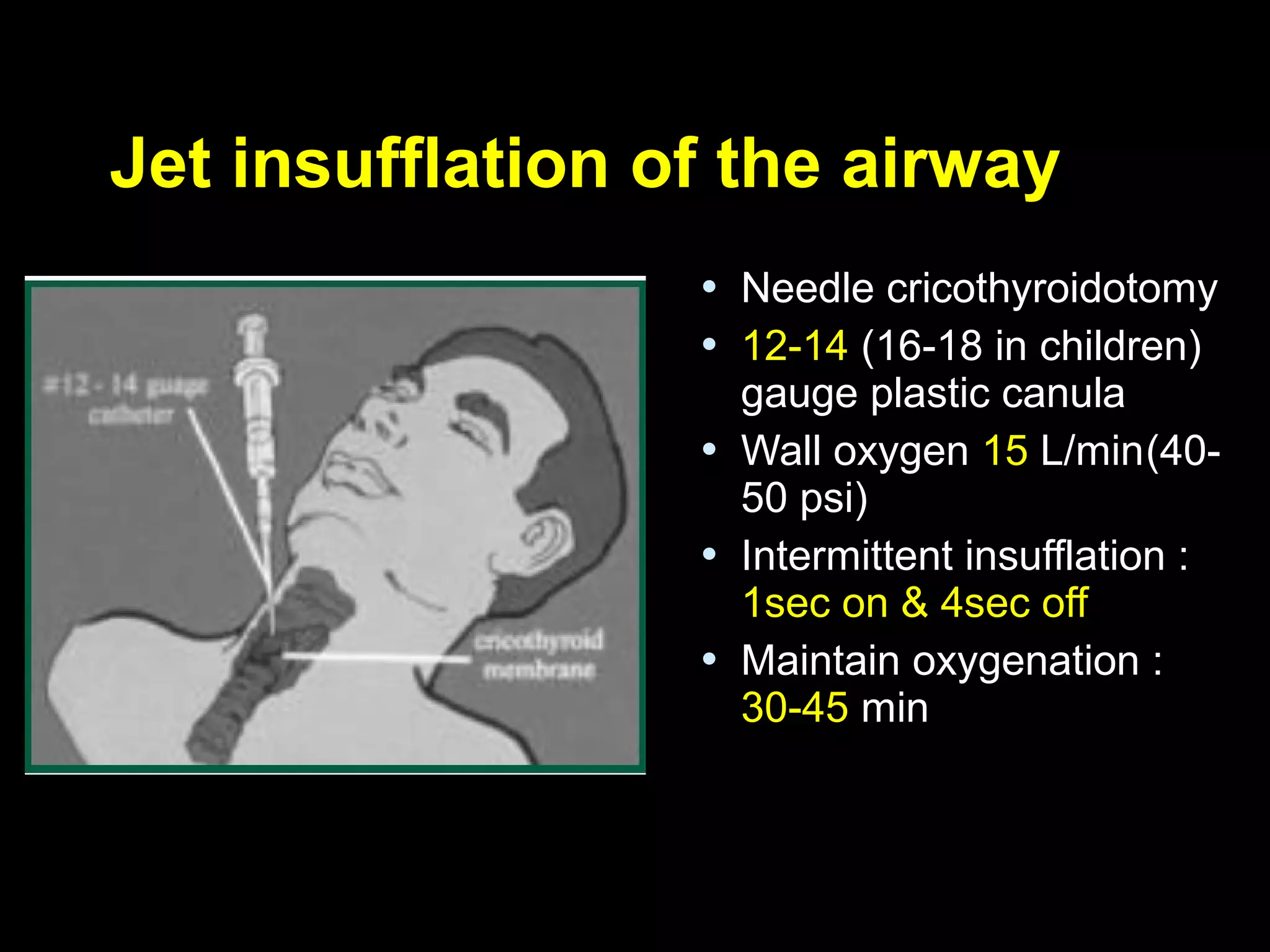 Jet insufflation of the airwayJet insufflation of the airway
 Needle cricothyroidotomyNeedle cricothyroidotomy
 12-1412-14 (16-18 in children)(16-18 in children)
gauge plastic canulagauge plastic canula
 Wall oxygenWall oxygen 1515 L/minL/min(40-(40-
50 psi)50 psi)
 Intermittent insufflation :Intermittent insufflation :
1sec on & 4sec off1sec on & 4sec off
 Maintain oxygenation :Maintain oxygenation :
30-4530-45 minmin
 