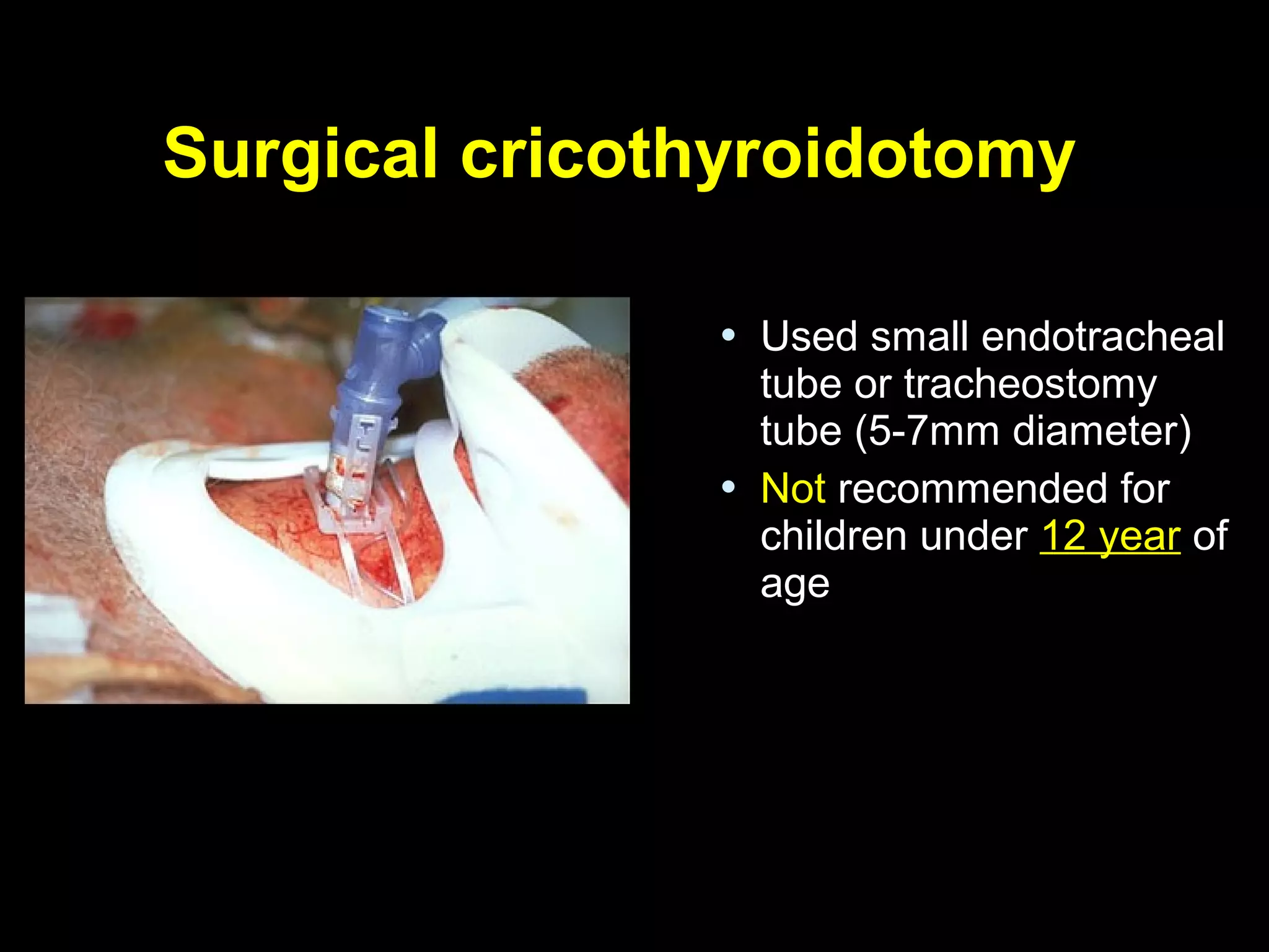 Surgical cricothyroidotomySurgical cricothyroidotomy
 Used small endotrachealUsed small endotracheal
tube or tracheostomytube or tracheostomy
tube (5-7mm diameter)tube (5-7mm diameter)
 NotNot recommended forrecommended for
children underchildren under 12 year12 year ofof
ageage
 