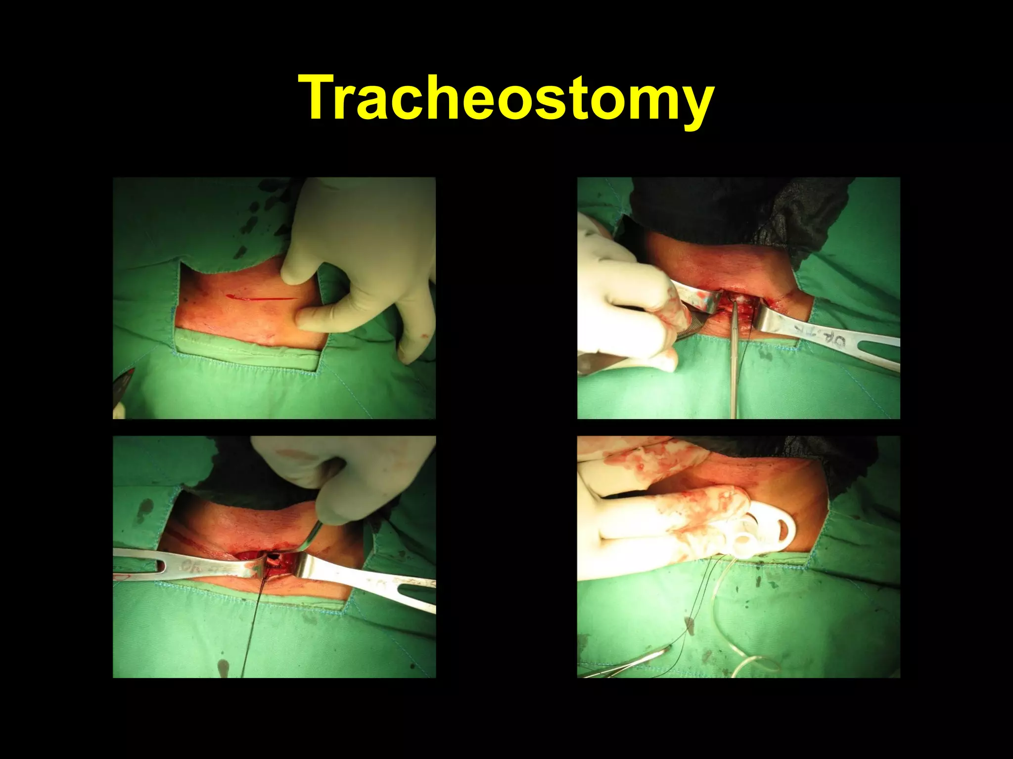 TracheostomyTracheostomy
 