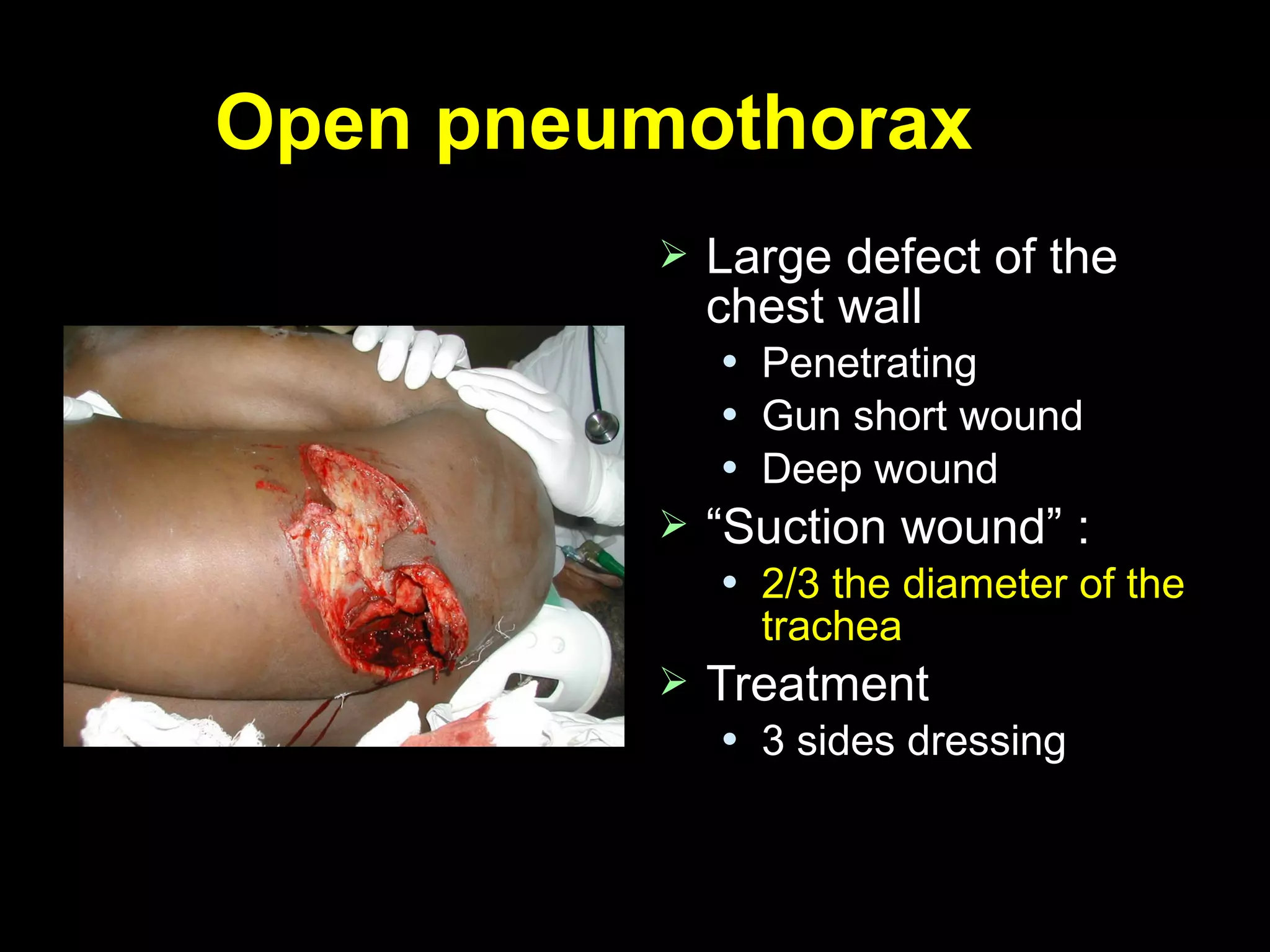 Open pneumothoraxOpen pneumothorax
 Large defect of theLarge defect of the
chest wallchest wall
 PenetratingPenetrating
 Gun short woundGun short wound
 Deep woundDeep wound
 ““Suction wound”Suction wound” ::
 2/3 the diameter of the2/3 the diameter of the
tracheatrachea
 TreatmentTreatment
 3 sides dressing3 sides dressing
 