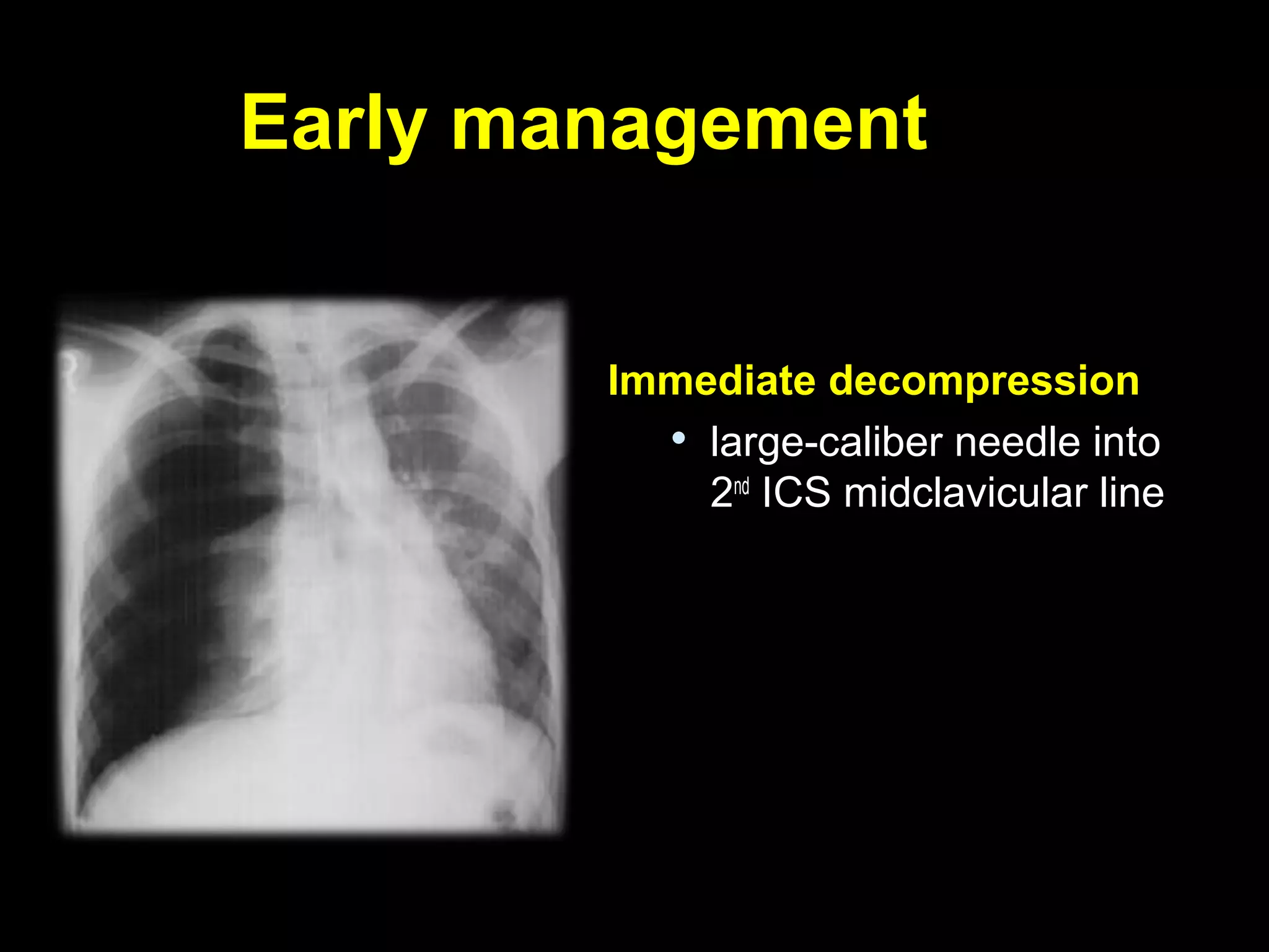 Early managementEarly management
Immediate decompressionImmediate decompression

large-caliber needle intolarge-caliber needle into
22ndnd
ICS midclavicular lineICS midclavicular line
 
