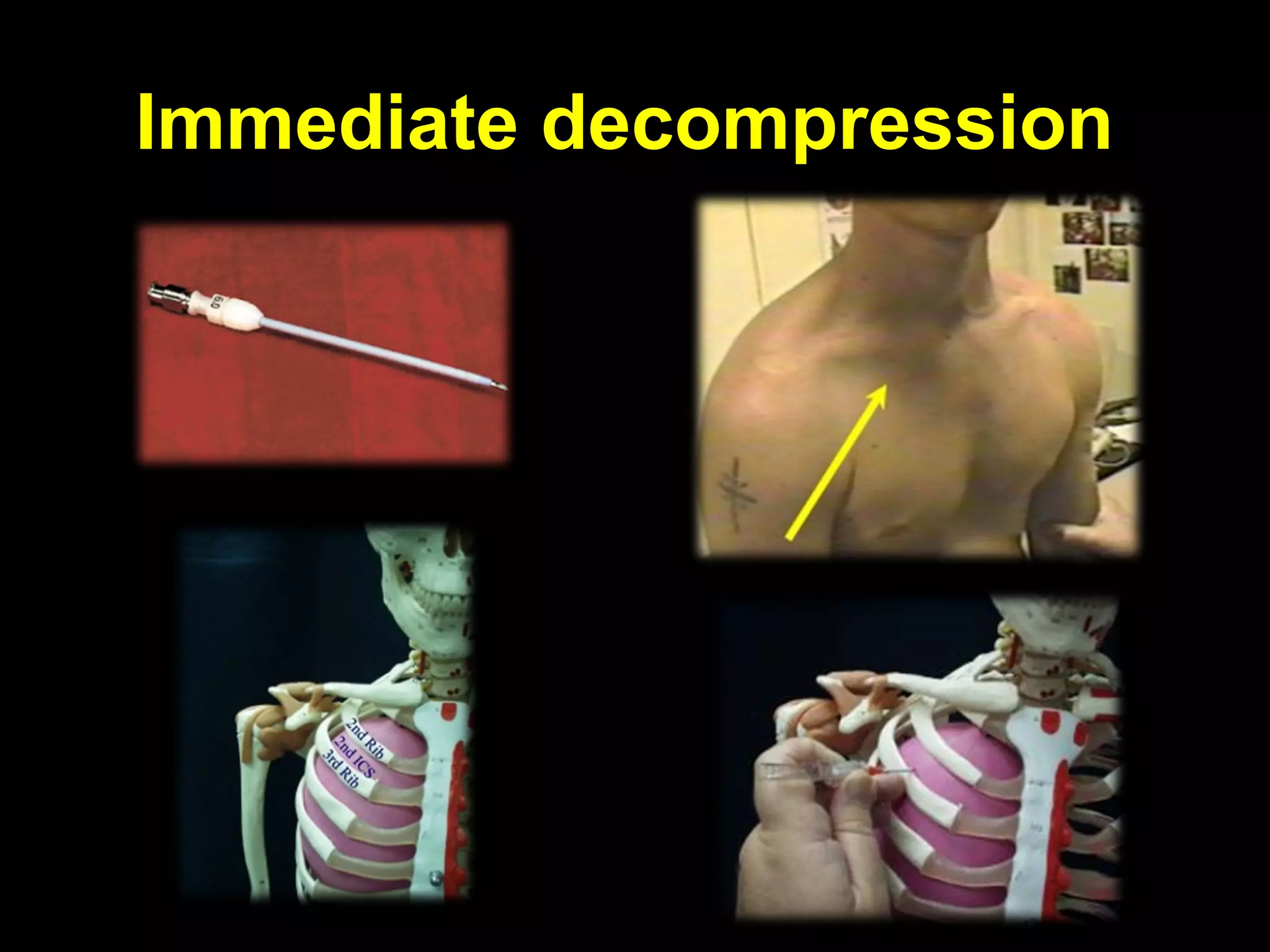 Immediate decompressionImmediate decompression
 