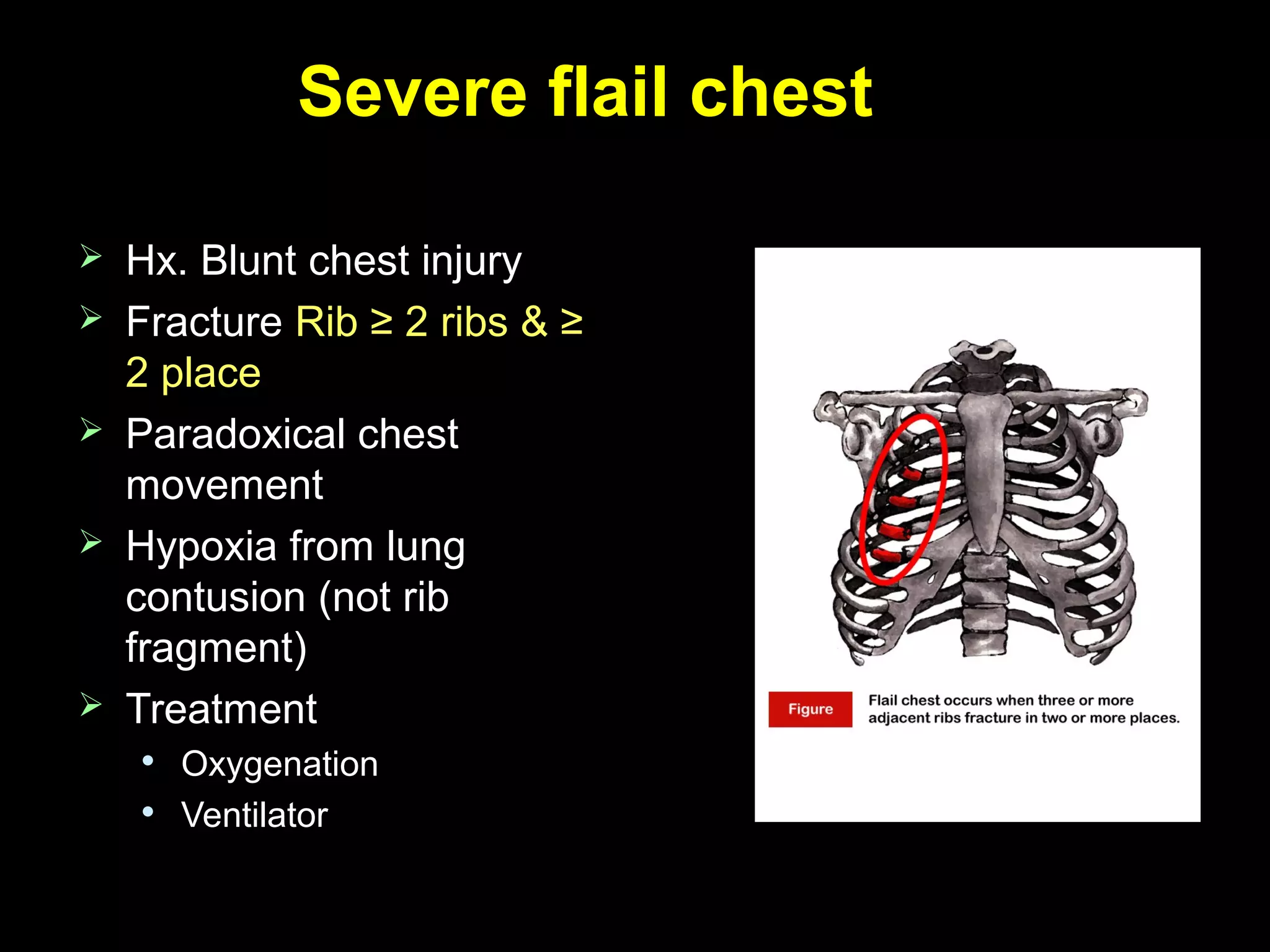 Severe flail chestSevere flail chest
 Hx. Blunt chest injuryHx. Blunt chest injury
 FractureFracture Rib ≥ 2 ribs & ≥Rib ≥ 2 ribs & ≥
2 place2 place
 Paradoxical chestParadoxical chest
movementmovement
 Hypoxia from lungHypoxia from lung
contusion (not ribcontusion (not rib
fragment)fragment)
 TreatmentTreatment

OxygenationOxygenation

VentilatorVentilator
 