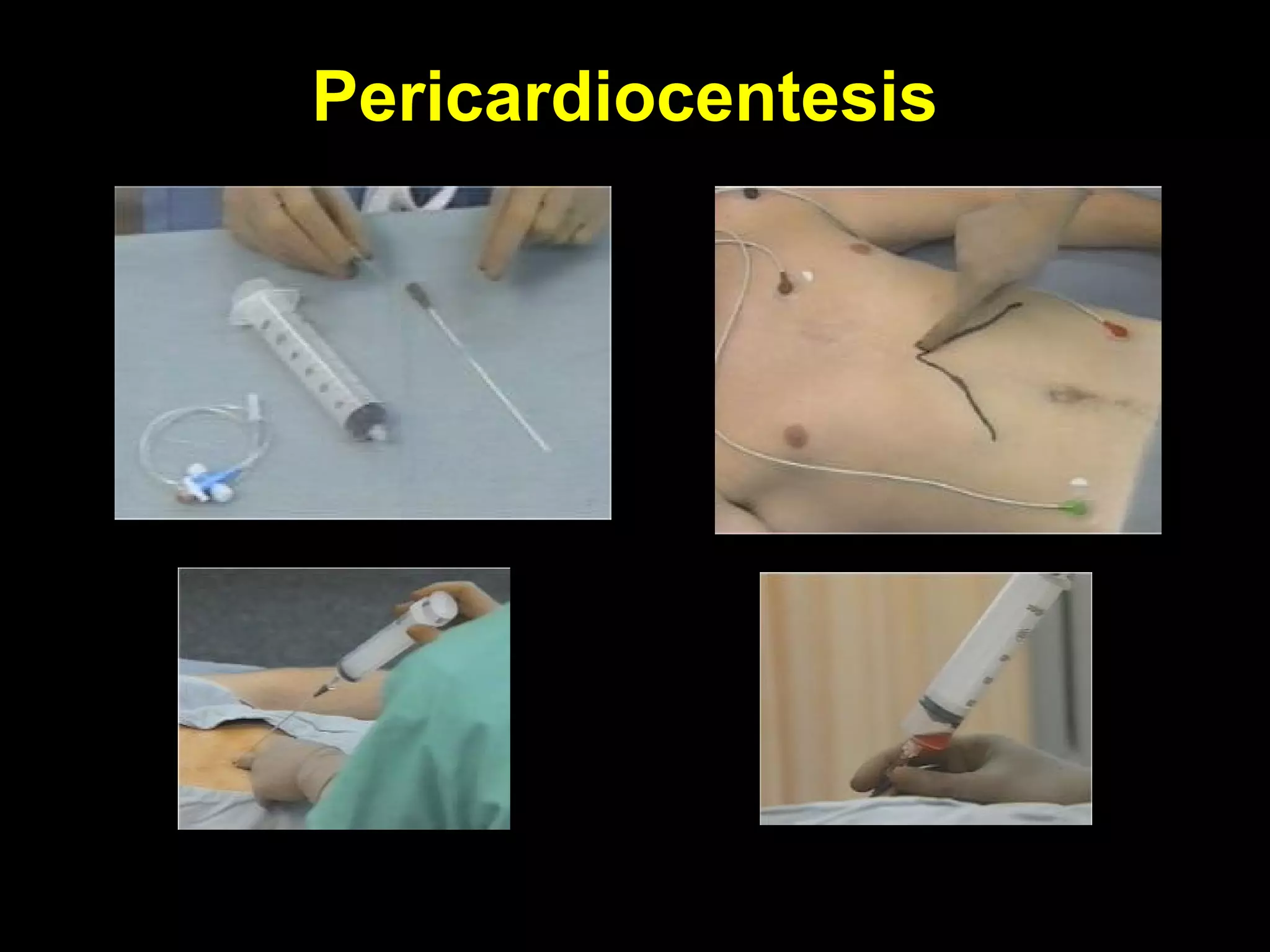 PericardiocentesisPericardiocentesis
 