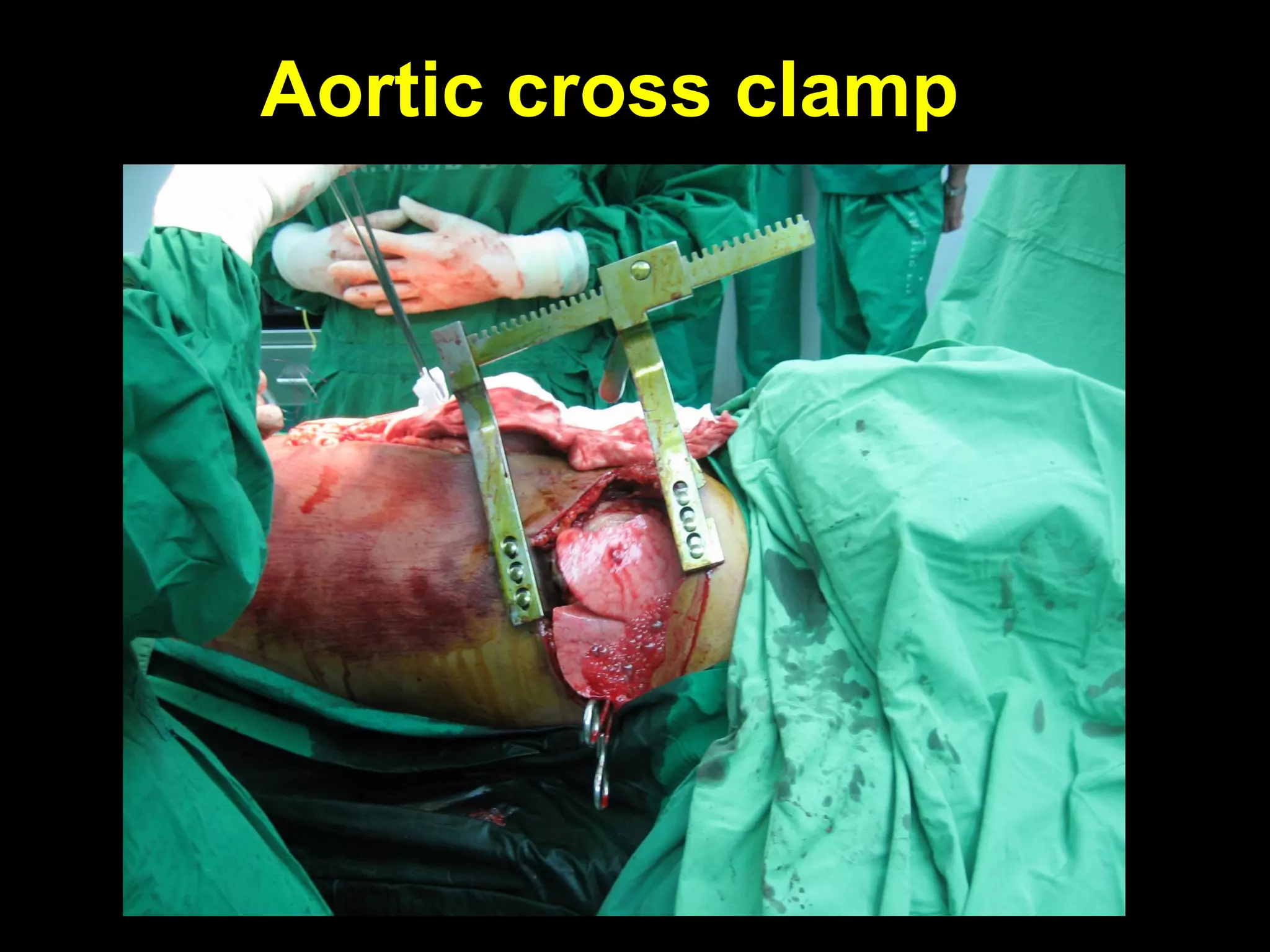 Aortic cross clampAortic cross clamp
 