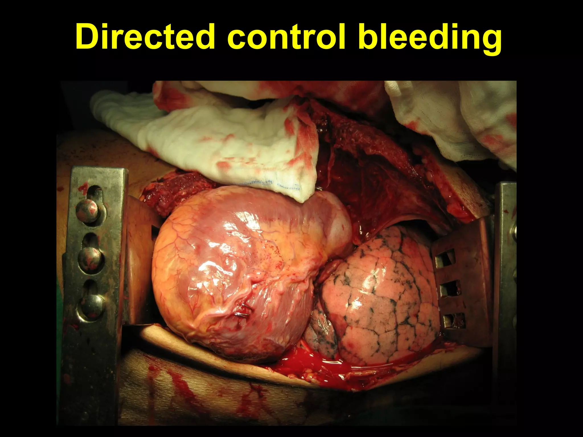Directed control bleedingDirected control bleeding
 