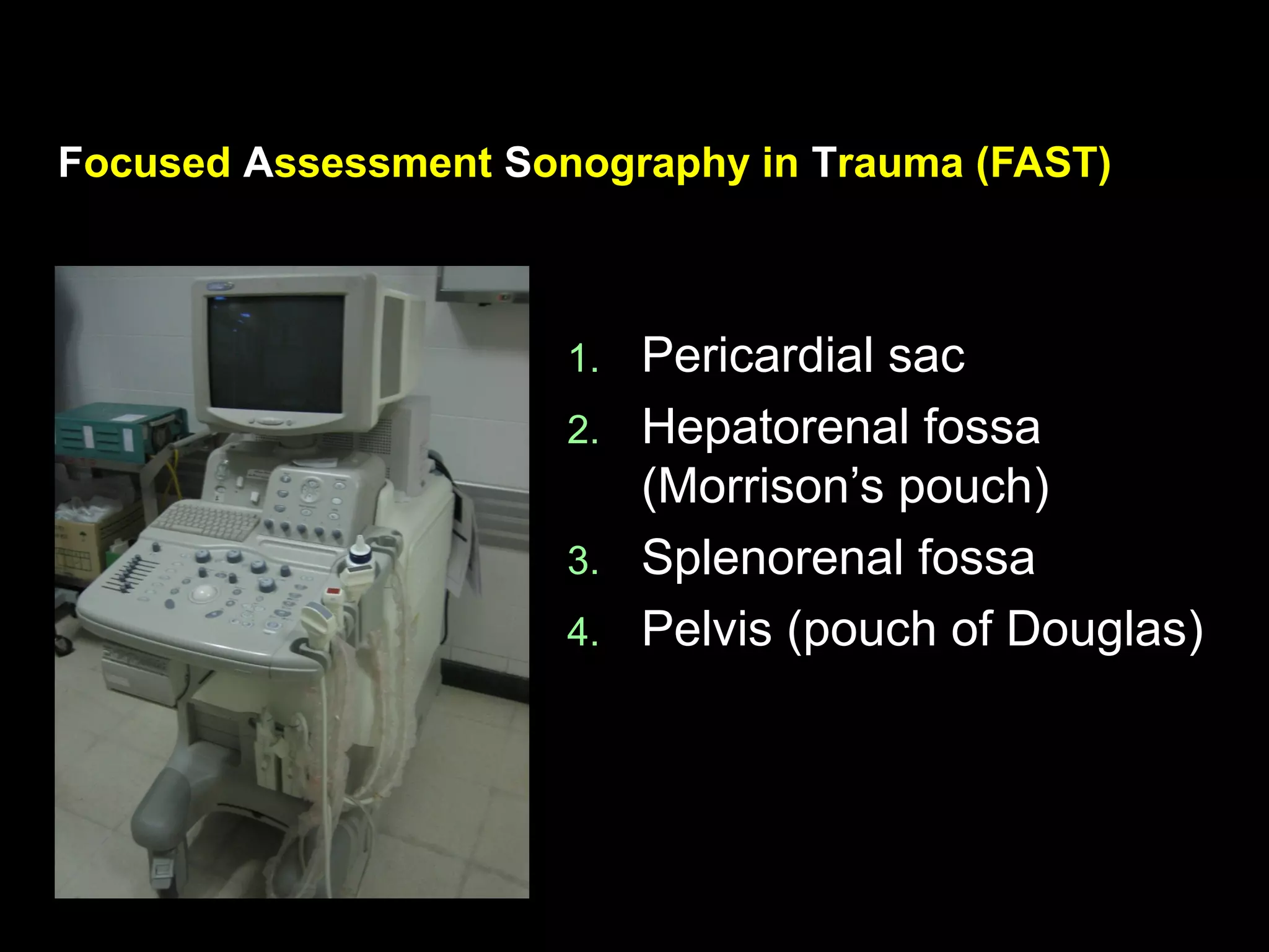 FFocusedocused AAssessmentssessment SSonography inonography in TTrauma (FAST)rauma (FAST)
1.1. Pericardial sacPericardial sac
2.2. Hepatorenal fossaHepatorenal fossa
(Morrison’s pouch)(Morrison’s pouch)
3.3. Splenorenal fossaSplenorenal fossa
4.4. Pelvis (pouch of Douglas)Pelvis (pouch of Douglas)
 