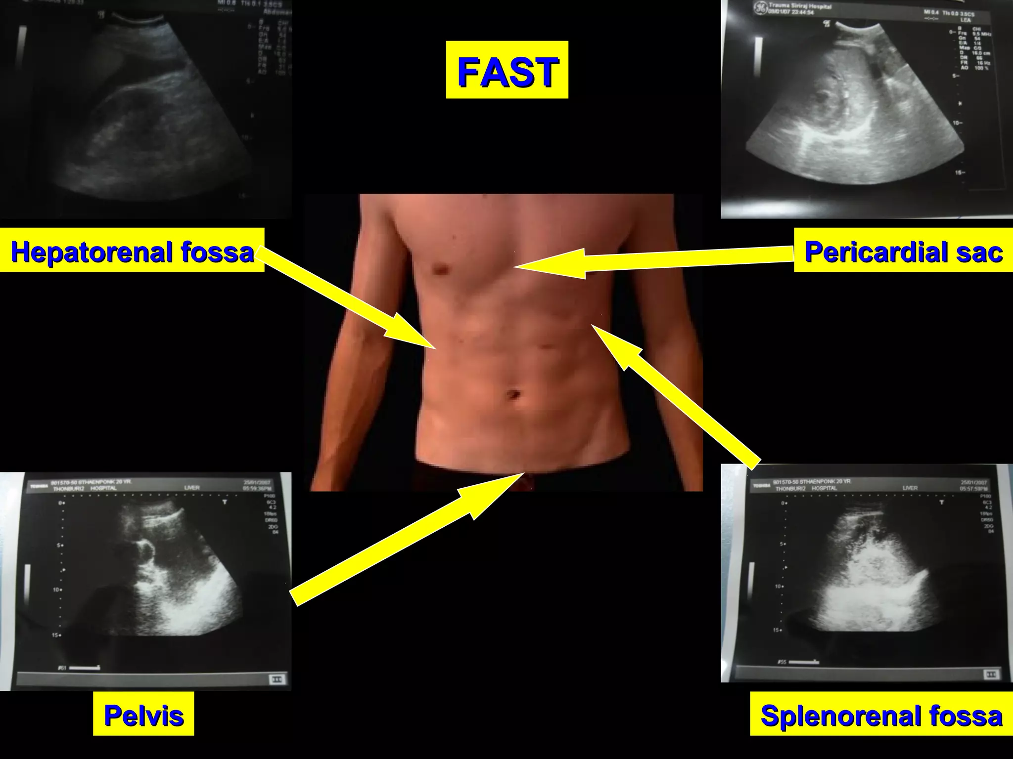 Pericardial sacPericardial sacHepatorenal fossaHepatorenal fossa
Splenorenal fossaSplenorenal fossaPelvisPelvis
FASTFAST
 