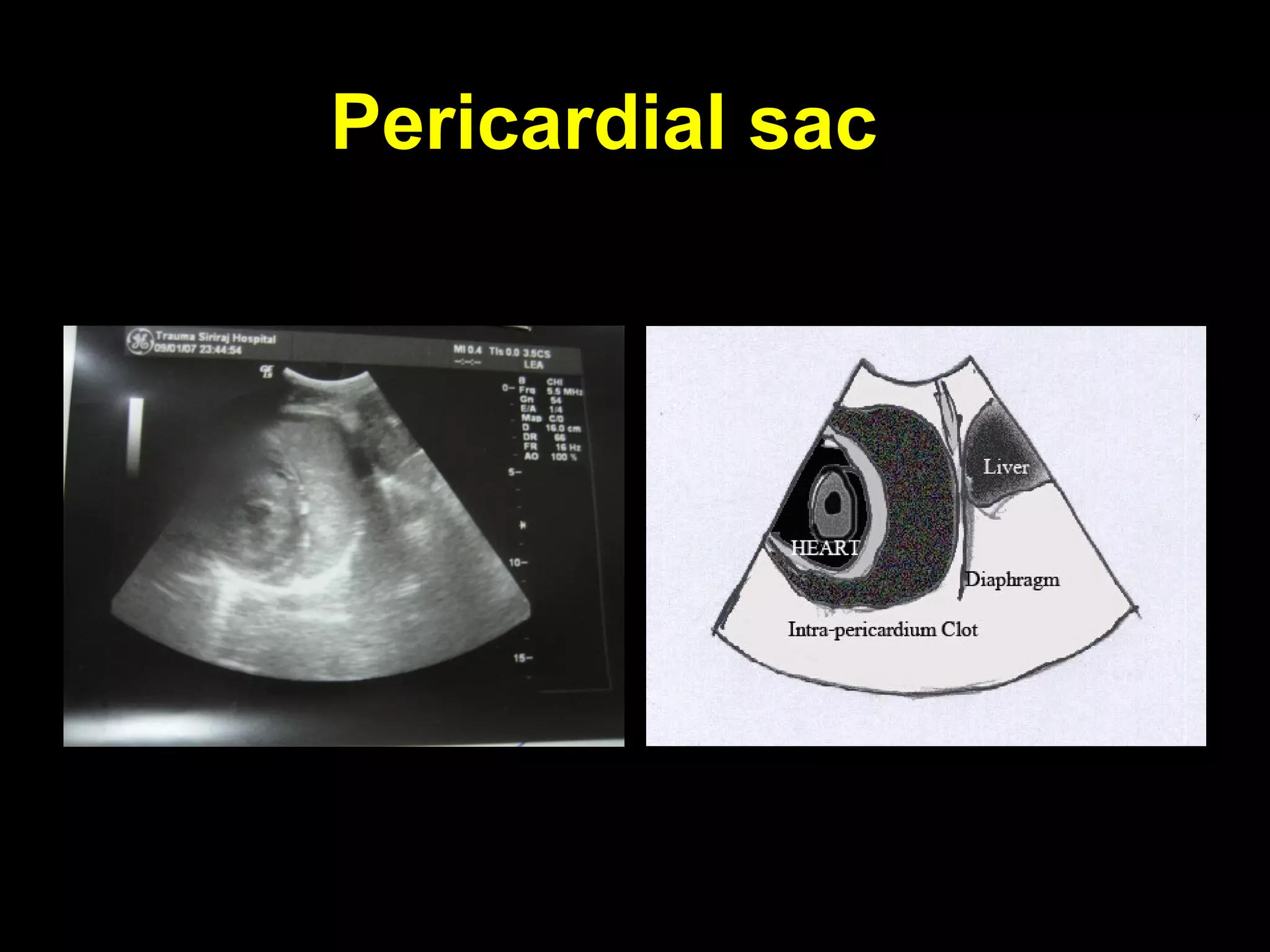 Pericardial sacPericardial sac
 