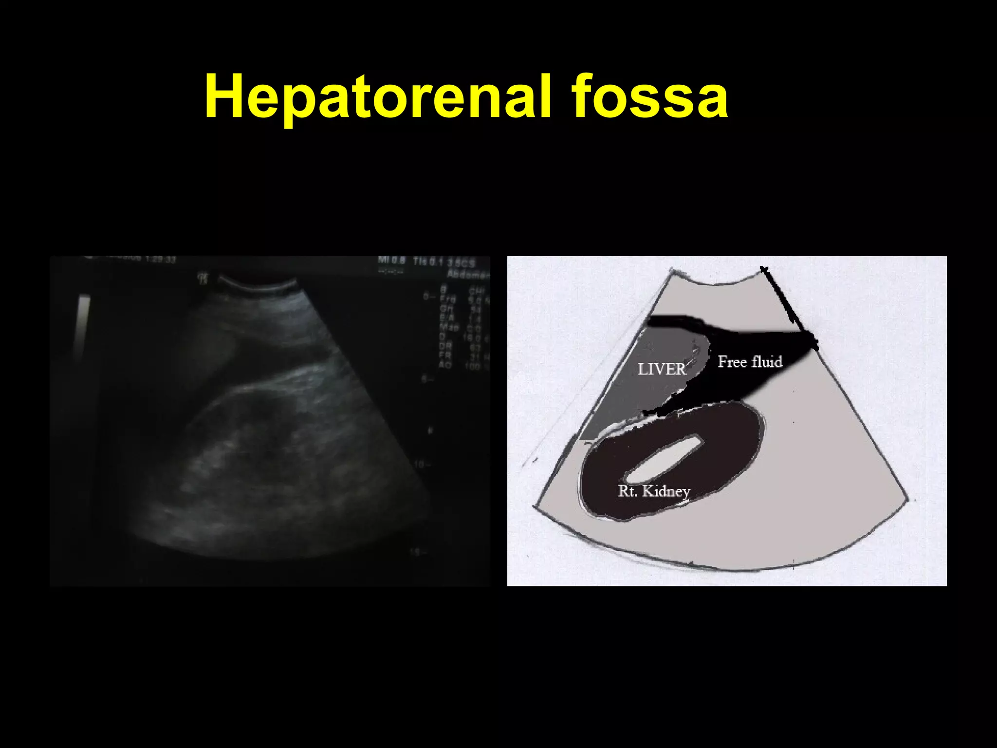 Hepatorenal fossaHepatorenal fossa
 