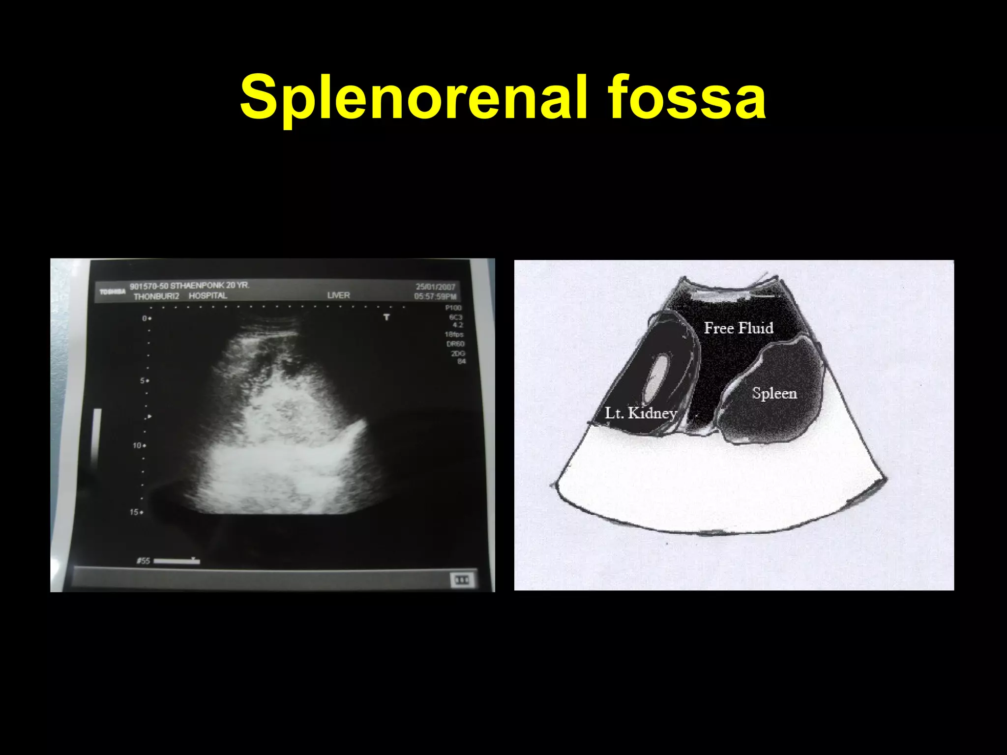 Splenorenal fossaSplenorenal fossa
 