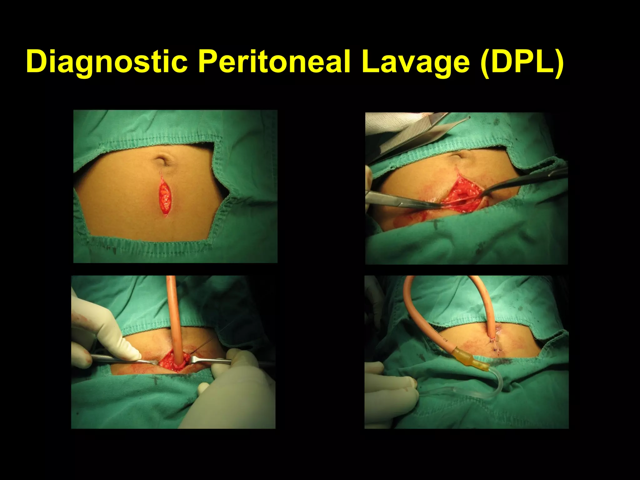 Diagnostic Peritoneal Lavage (DPL)Diagnostic Peritoneal Lavage (DPL)
 