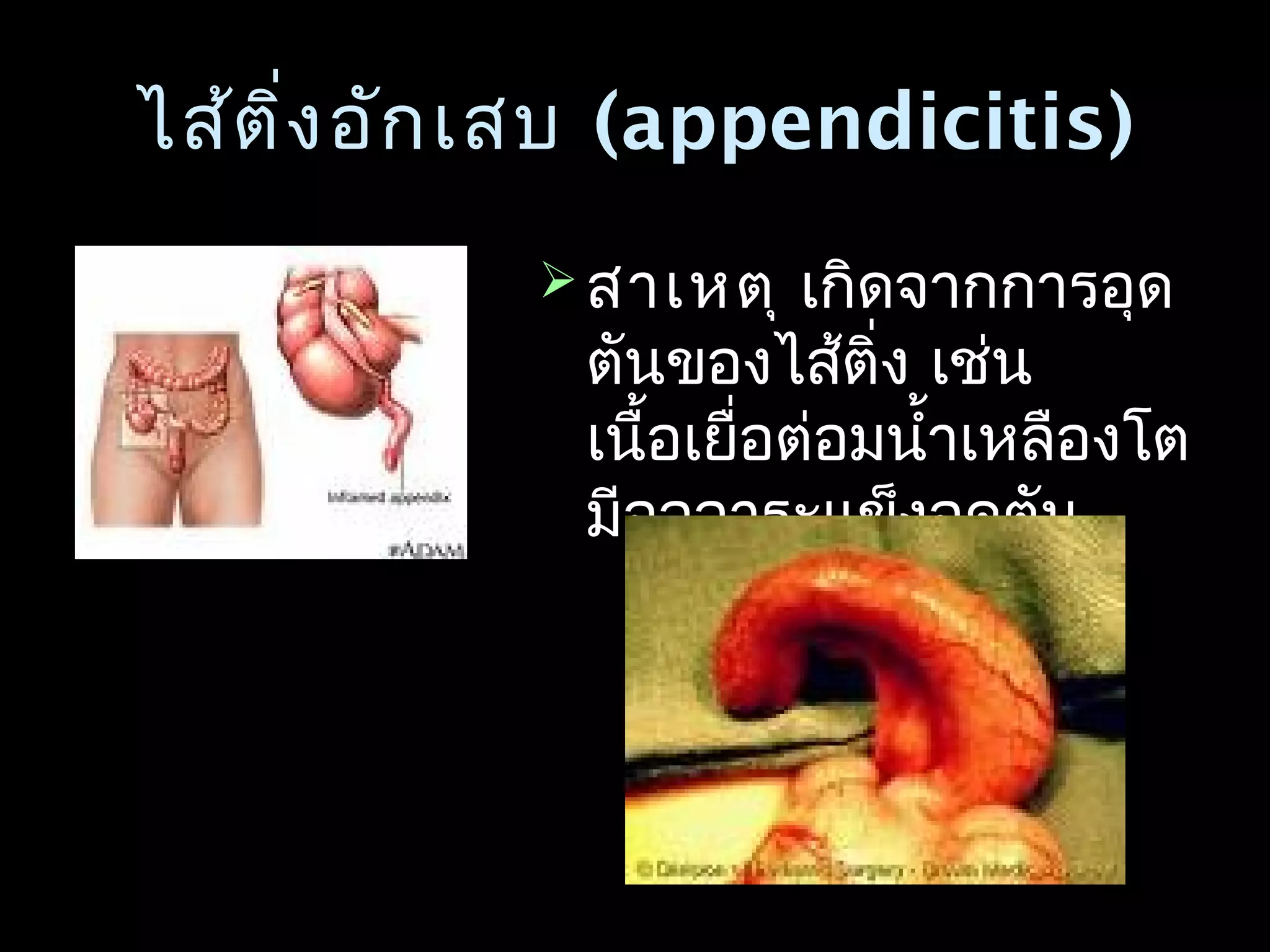 ไส้ติ่งอักเสบไส้ติ่งอักเสบ (appendicitis)(appendicitis)
 สาเหตุสาเหตุ เกิดจากการอุดเกิดจากการอุด
ตันของไส้ติ่ง เช่นตันของไส้ติ่ง เช่น
เนื้อเยื่อต่อมนำ้าเหลืองโตเนื้อเยื่อต่อมนำ้าเหลืองโต
มีอุจจาระแข็งอุดตันมีอุจจาระแข็งอุดตัน
 