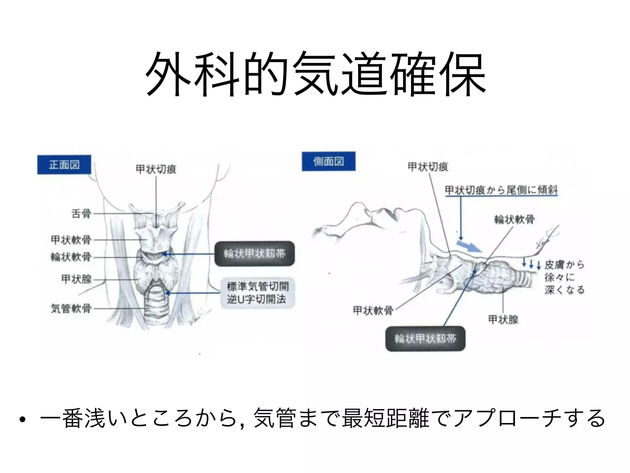 外科的気道確保
• 一番浅いところから, 気管まで最短距離でアプローチする
 