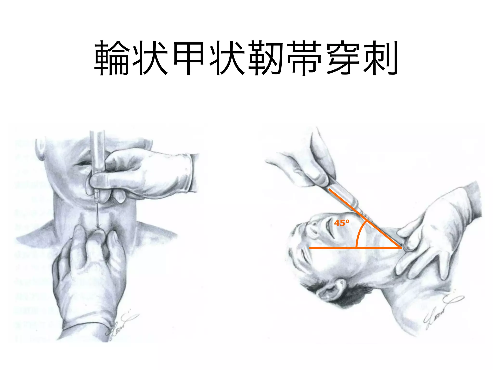 輪状甲状靭帯 刺
45°
 