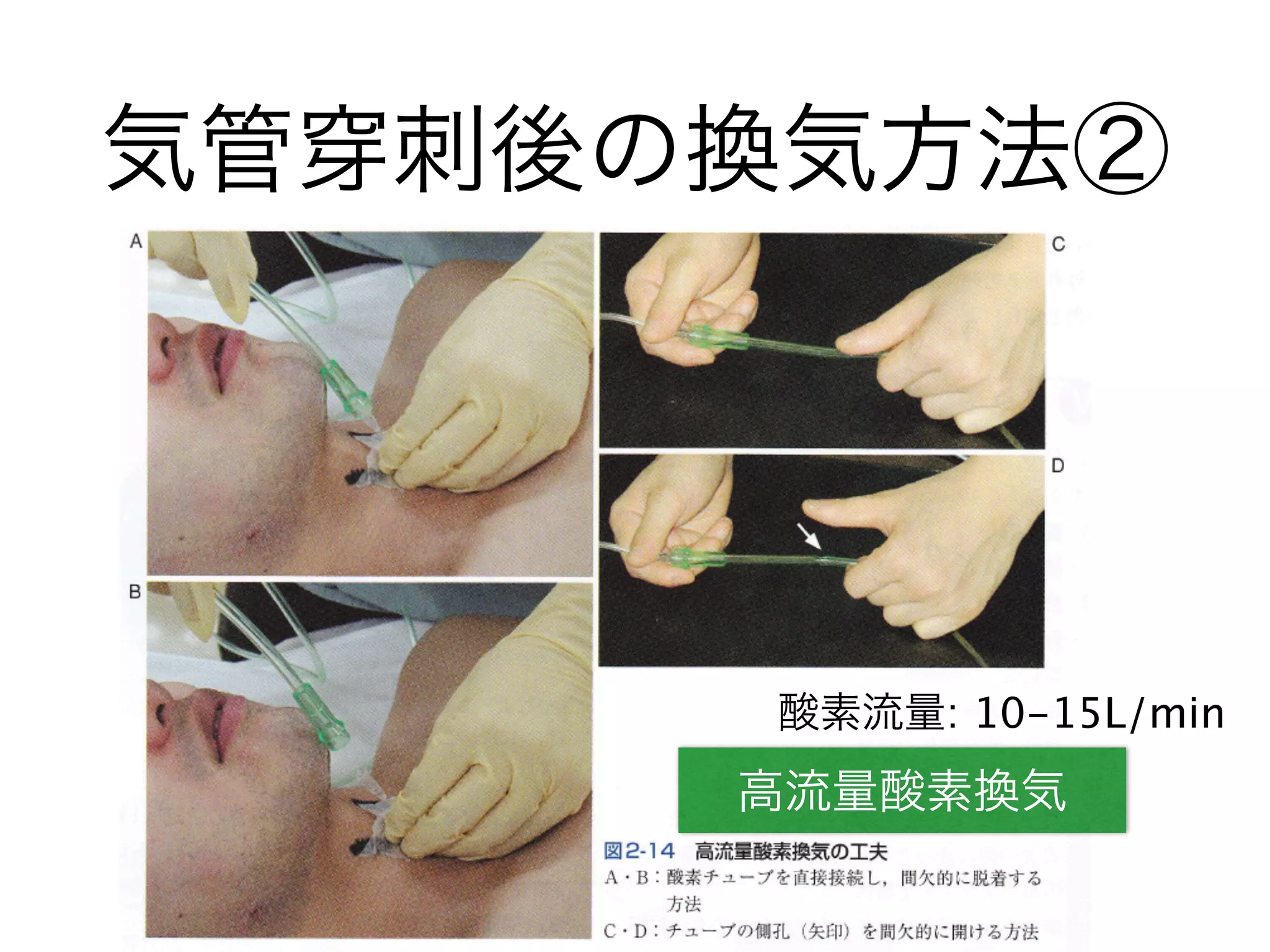 気管 刺後の換気方法②
高流量酸素換気
酸素流量: 10-15L/min
 