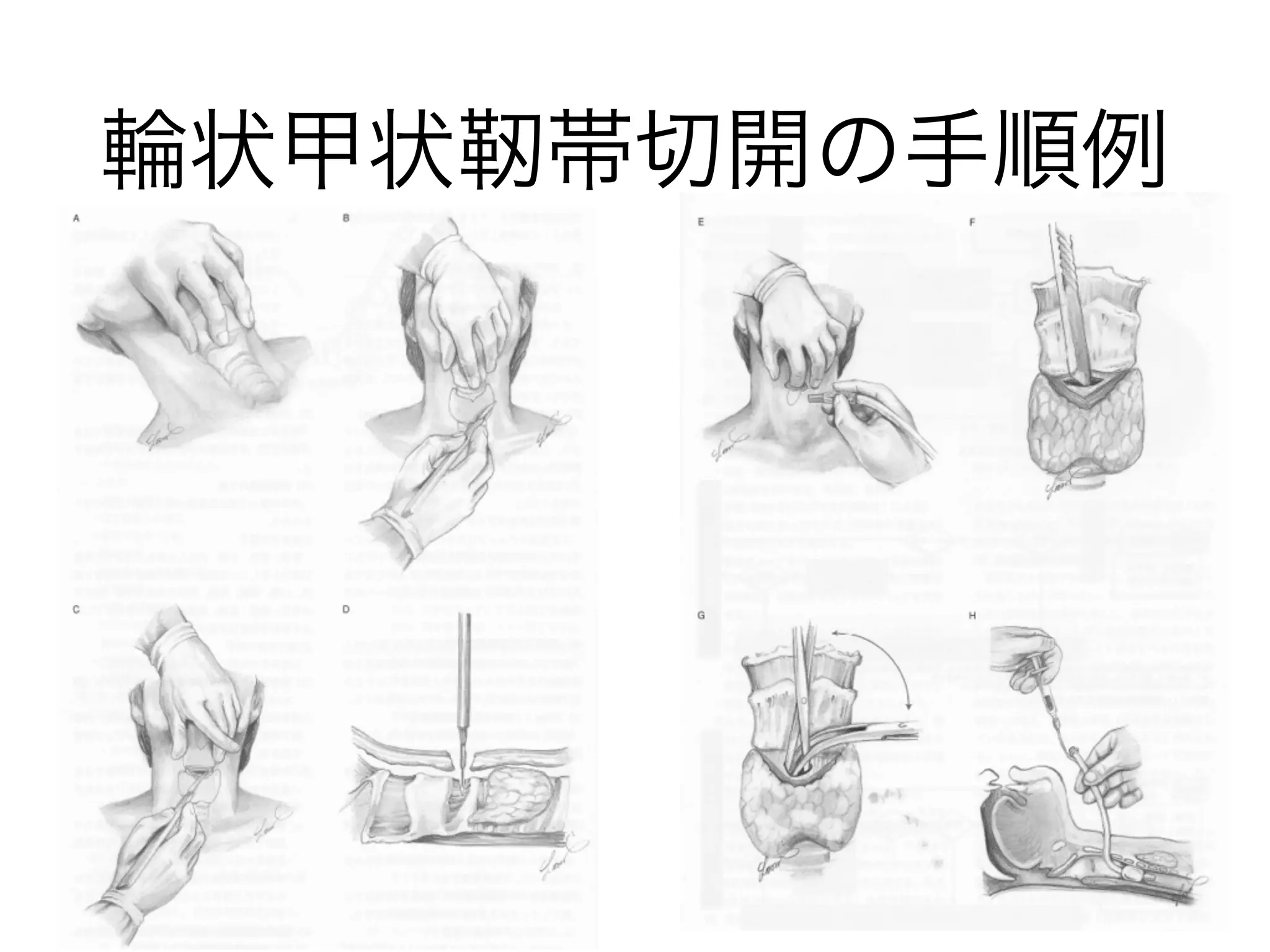 輪状甲状靭帯切開の手順例
 