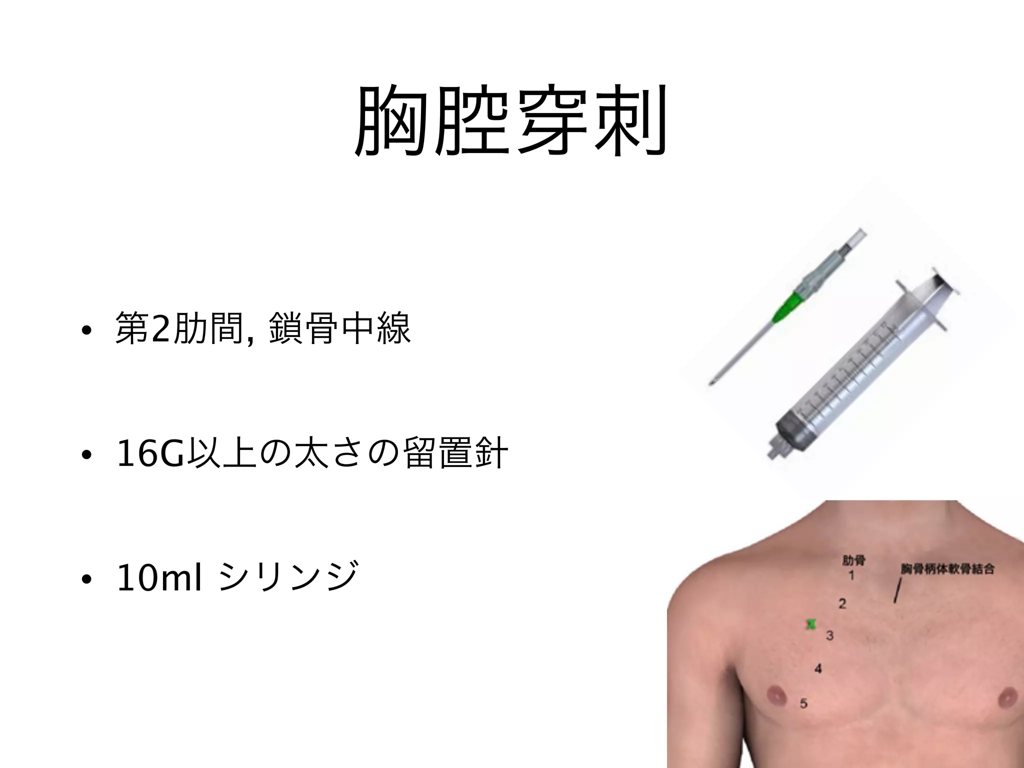 胸腔 刺
• 第2肋間, 鎖骨中線
• 16G以上の太さの留置針
• 10ml シリンジ
 