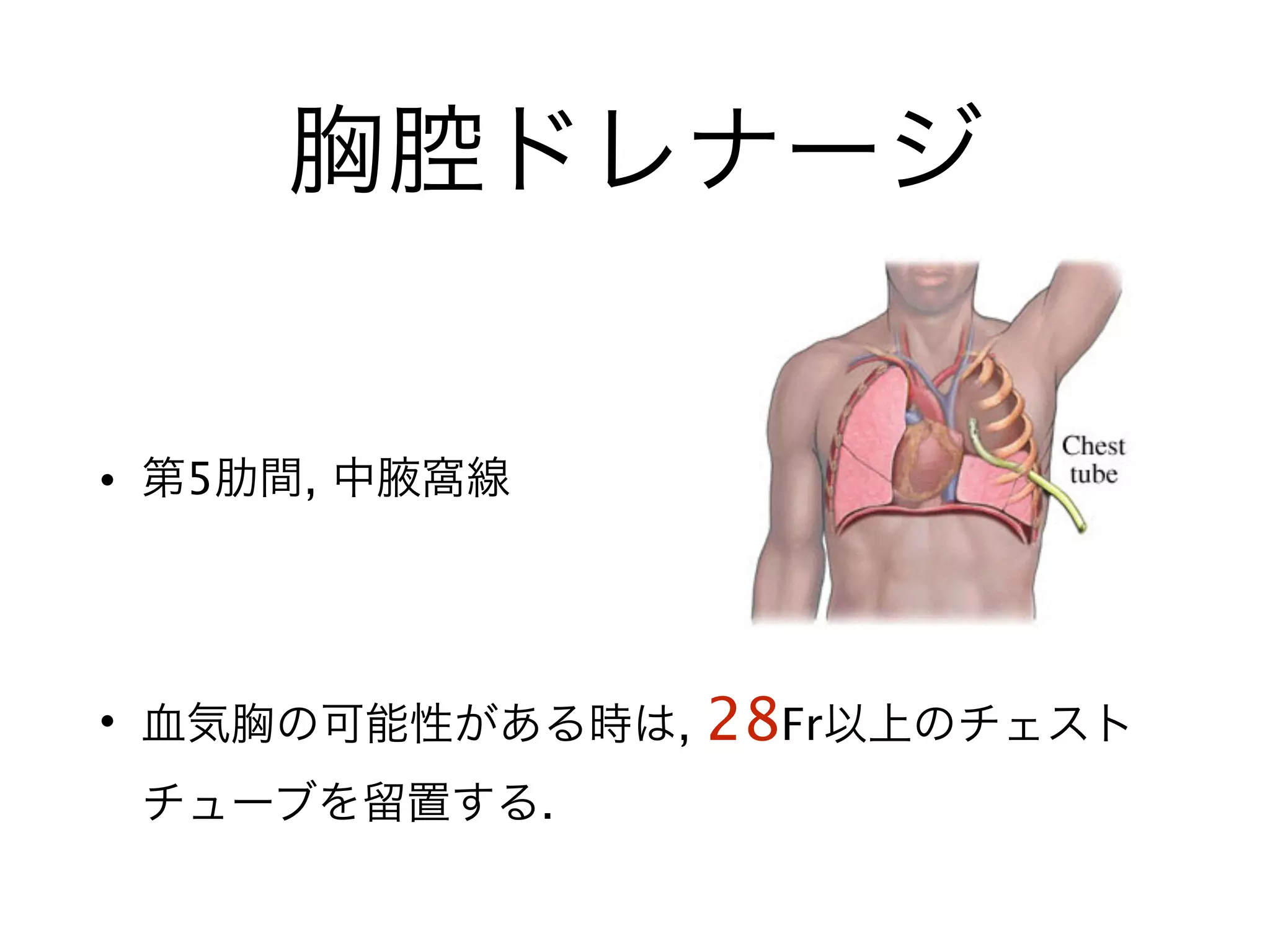 胸腔ドレナージ
• 第5肋間, 中腋窩線
!
• 血気胸の可能性がある時は, 28Fr以上のチェスト
チューブを留置する.
 