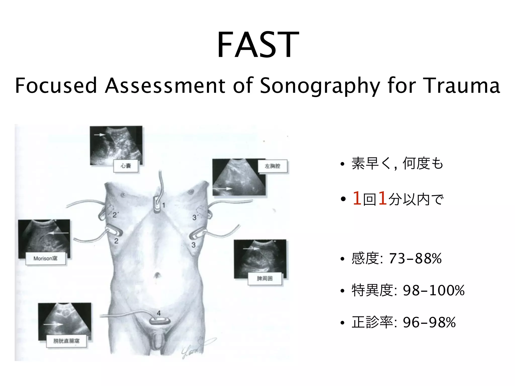 FAST
Focused Assessment of Sonography for Trauma
• 素早く, 何度も
• 1回1分以内で
!
• 感度: 73-88%
• 特異度: 98-100%
• 正診率: 96-98%
 