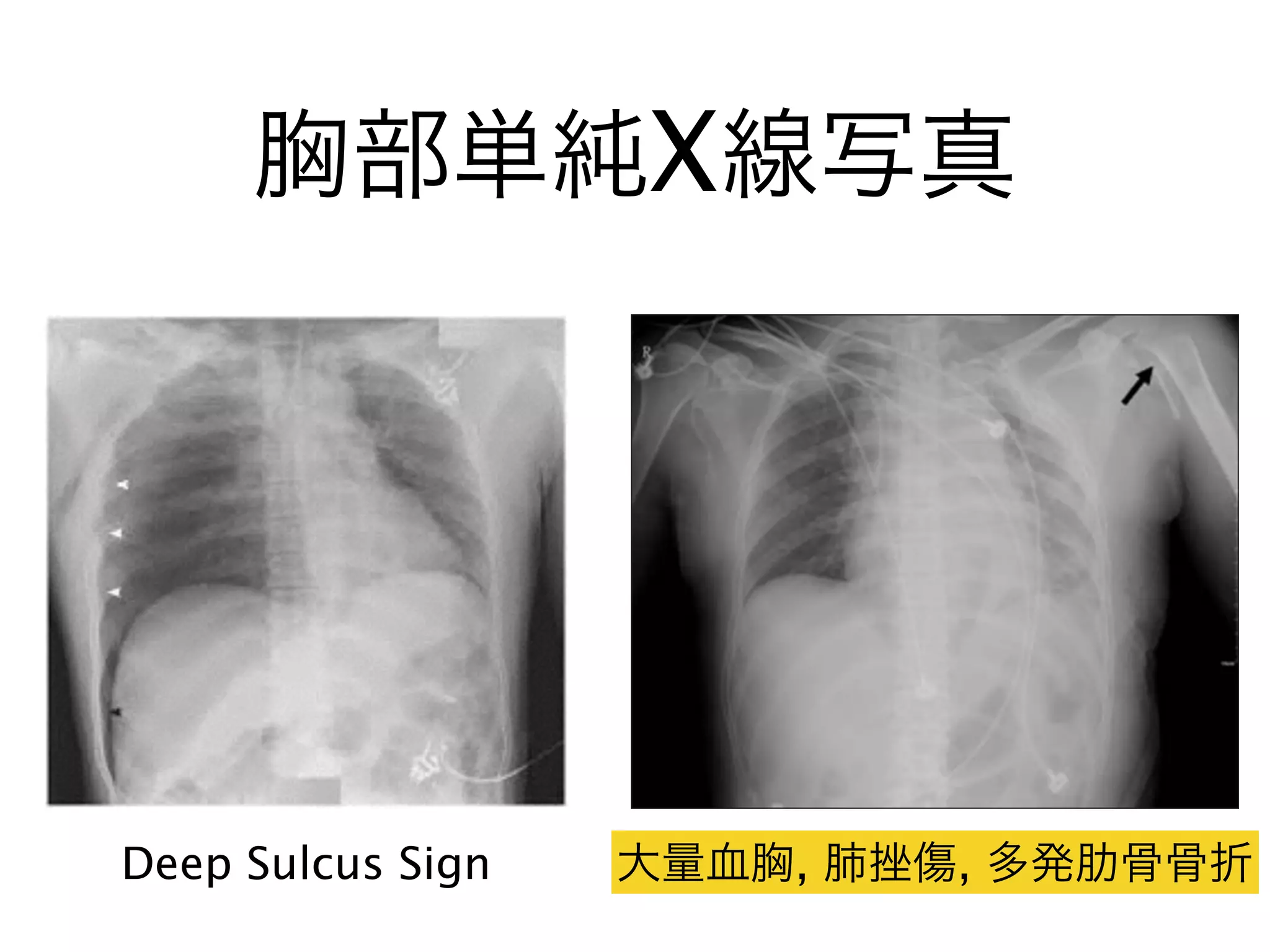 胸部単純X線写真
Deep Sulcus Sign 大量血胸, 肺挫傷, 多発肋骨骨折
 