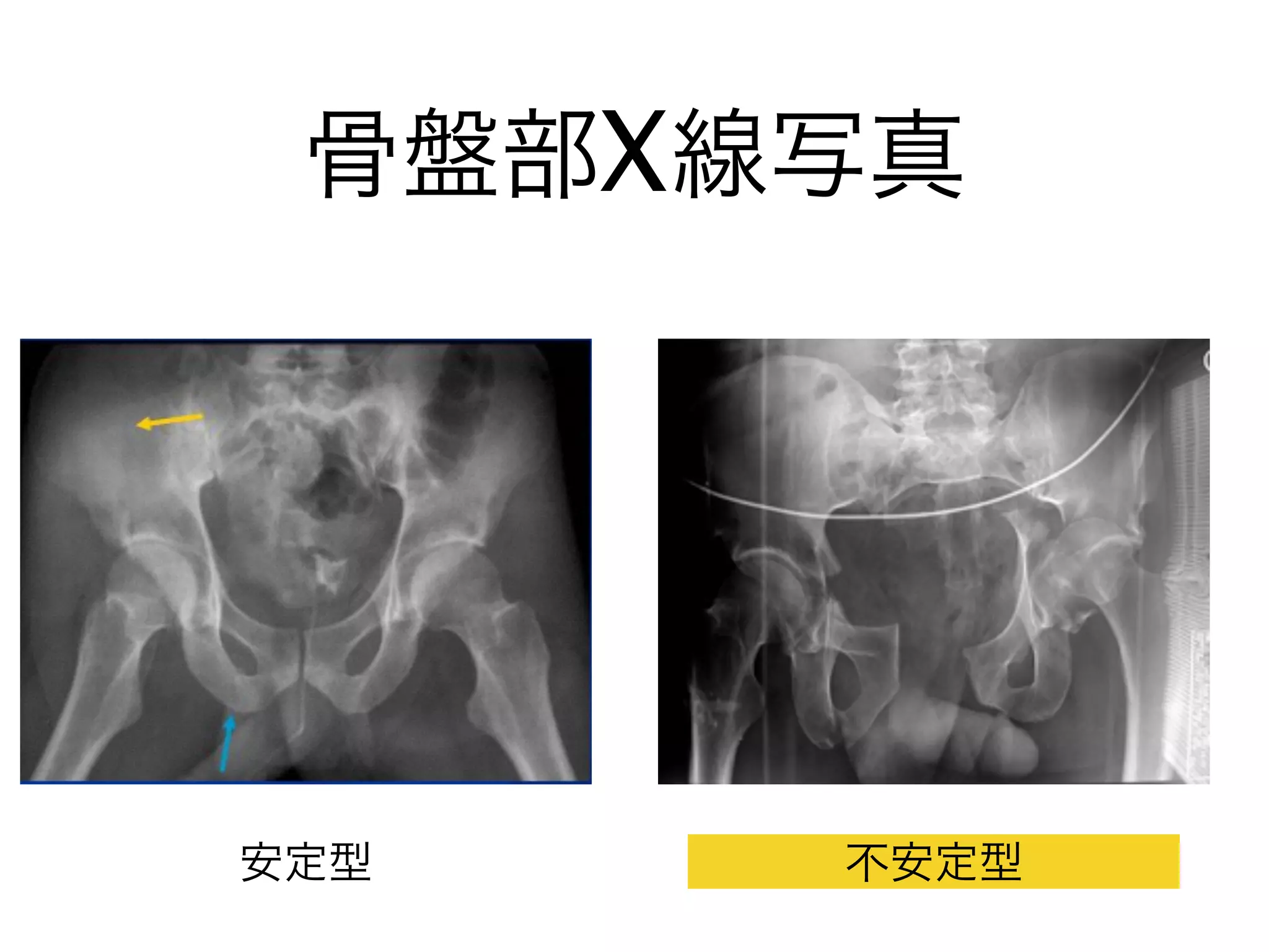 骨盤部X線写真
安定型 不安定型
 