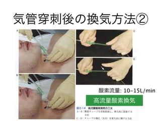 気管 刺後の換気方法②
高流量酸素換気
酸素流量: 10-15L/min
 