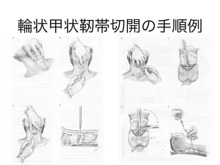 輪状甲状靭帯切開の手順例
 