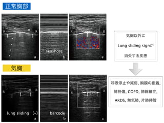 外傷性気胸の超音波診断
田  徹，他
，胸壁には呼吸性の動揺がないので平行線が多
出されるが，pleural line及びその深部に描出さ
多重反射よるアーチファクトには呼吸性の動揺
こるので砂浜様に描出される。Lichtensteinら
壁にあたる平行線の部位を砂浜に打ち寄せる波
え，seashore sign として報告している 30)
（Fig.
。一方，気胸の場合はpleural lineより深部のアー
ァクトにも呼吸性の動揺がみられないので，平
Acute respiratory distress syndrome（以下ARDS）23,37)
，無
気肺38)
，片肺挿管5,38)
では気胸がなくてもlung sliding
がみられないことが挙げられる。
2）Comet-tail artifact（B line）
Comet-tail artifactは，ある物質と，それを取り囲
む音響インピーダンスの極端に異なる物質の間で起
こる多重反射で，はっきりとした輪郭を持った線状
高輝度エコーのことを指す39)
。肺では，胸膜下の肺
Fig. 1. Longitudinal ultrasound images from the linear probe of the uninjured left anterior chest in a 70-year-old man
who presented with right lateral chest pain after falling from a ladder.
a: B-mode image shows the pleural line (white arrows) and a comet-tail artifact (arrowheads). Lung sliding was observed
with real-time images.
b: M-mode image shows seashore sign.
c: Color Doppler image shows presence of the Doppler signal on artifacts.
R: rib, IM: intercostal muscle
正常胸部
気胸
lung sliding （-）
seashore
barcode
気胸以外に
Lung sliding signが
消失する疾患
!
!
呼吸停止や減弱, 胸膜の癒着,
肺挫傷, COPD, 肺線維症,
ARDS, 無気肺, 片肺挿管
 
