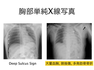 胸部単純X線写真
Deep Sulcus Sign 大量血胸, 肺挫傷, 多発肋骨骨折
 