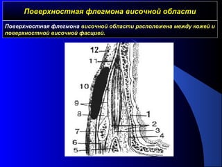 Поверхностная флегмона височной областиПоверхностная флегмона височной области
Поверхностная флегмона височной области расположена между кожей и
поверхностной височной фасцией.
 