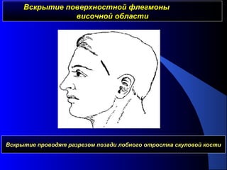 Вскрытие поверхностной флегмоныВскрытие поверхностной флегмоны
височной областивисочной области
Вскрытие проводят разрезом позади лобного отростка скуловой кости
 
