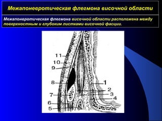 Межапоневротическая флегмона височной областиМежапоневротическая флегмона височной области
Межапонвротическая флегмона височной области расположена между
поверхностным и глубоким листками височной фасции.
 