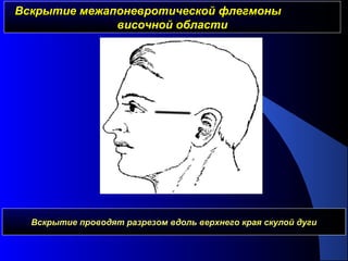 Вскрытие межапоневротической флегмоныВскрытие межапоневротической флегмоны
височной областивисочной области
Вскрытие проводят разрезом вдоль верхнего края скулой дуги
 