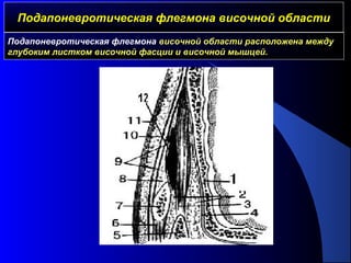 Подапоневротическая флегмона височной областиПодапоневротическая флегмона височной области
Подапоневротическая флегмона височной области расположена между
глубоким листком височной фасции и височной мышцей.
 