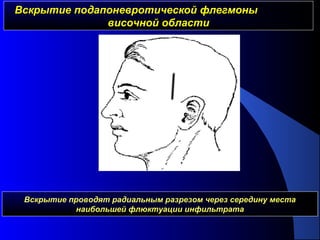 Вскрытие подапоневротической флегмоныВскрытие подапоневротической флегмоны
височной областивисочной области
Вскрытие проводят радиальным разрезом через середину места
наибольшей флюктуации инфильтрата
 