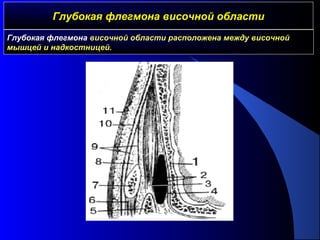 Глубокая флегмона височной областиГлубокая флегмона височной области
Глубокая флегмона височной области расположена между височной
мышцей и надкостницей.
 